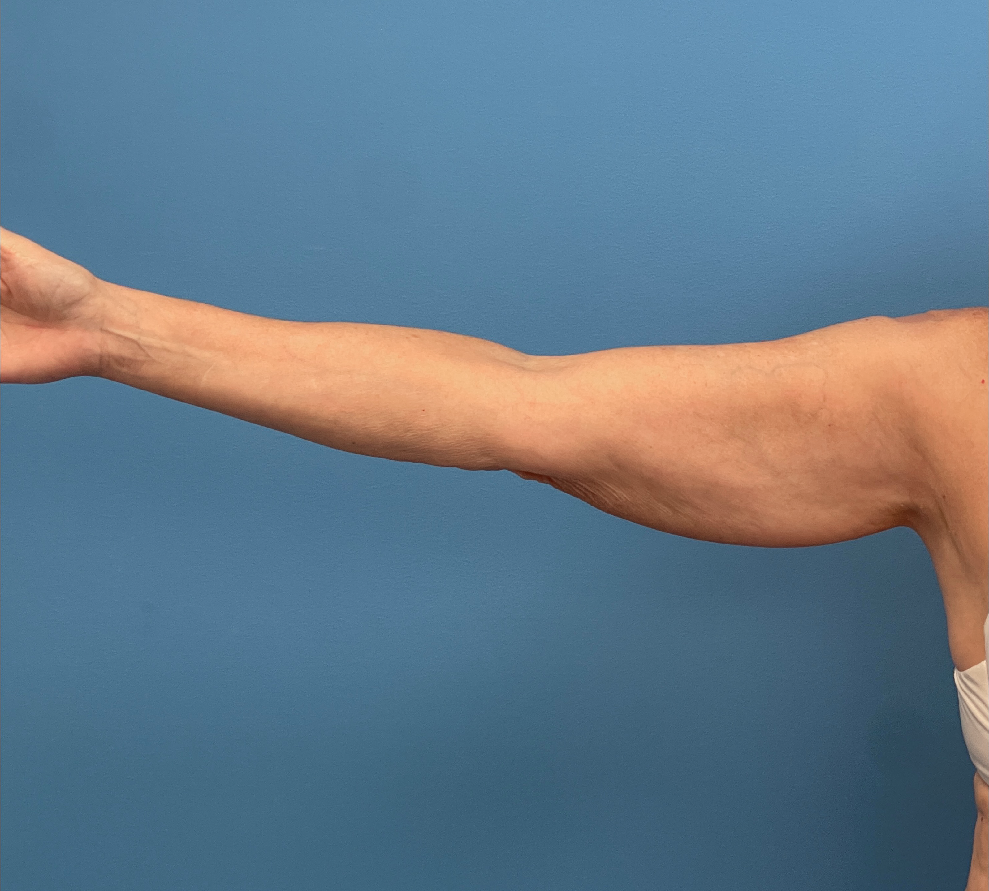Liposuction-Case--23690-2 | Before Body 2
