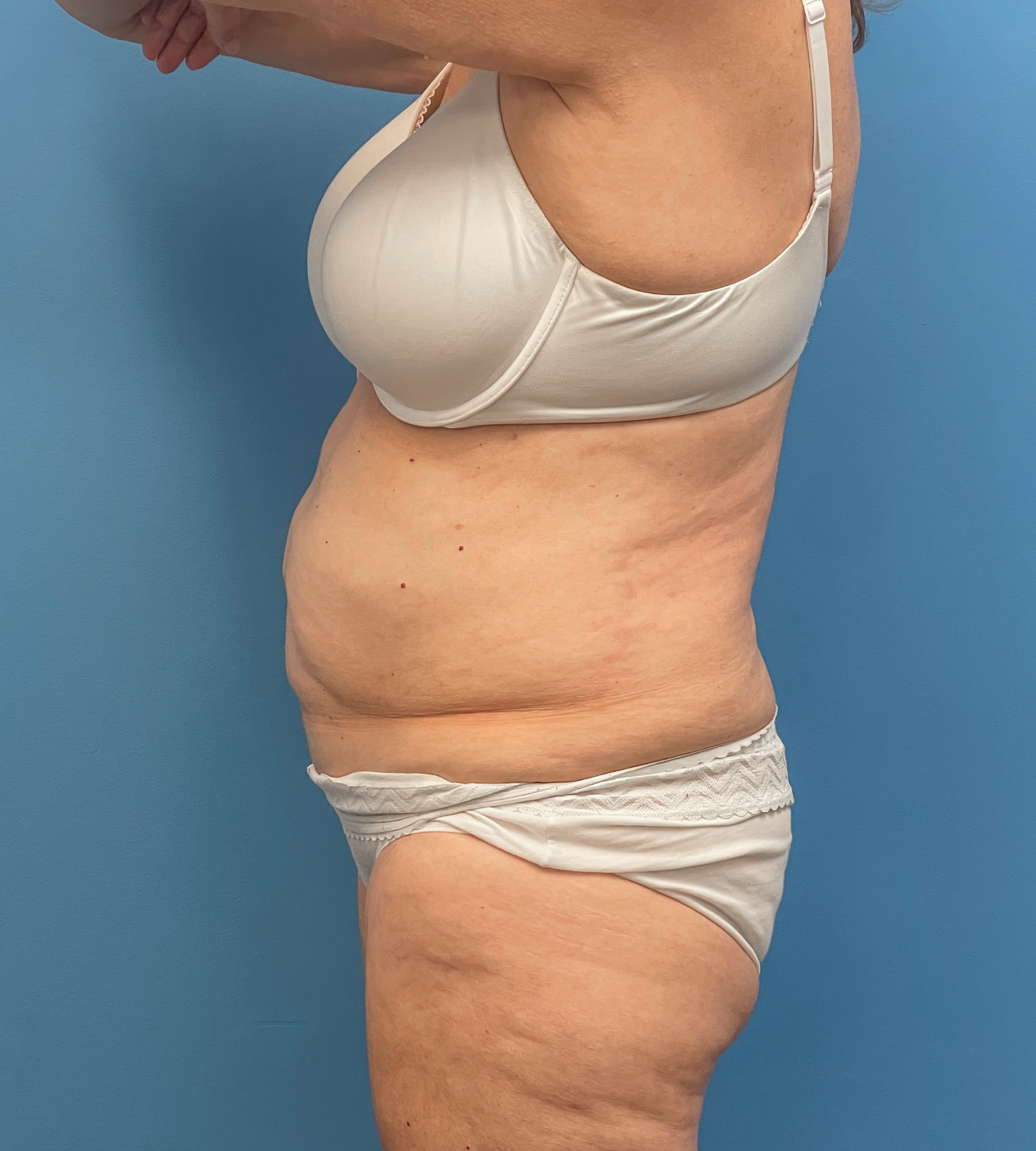 Abdominoplasty-Case--23690 | Before Body 2