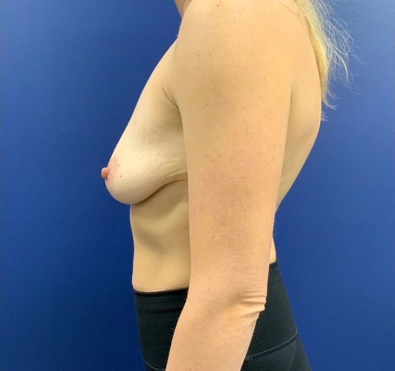 Breast-Augmentation-Case--20570 | Before Breast Augmentation 3