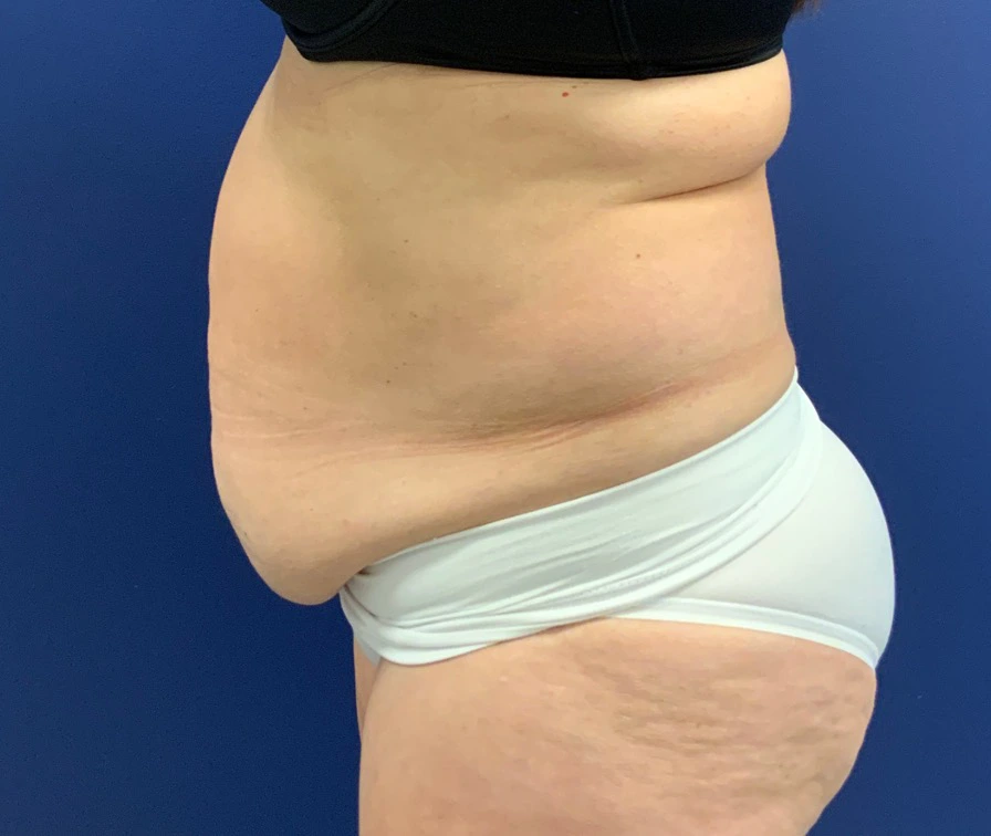 Abdominoplasty-Case--21804 | Before Tummy Tuck 2