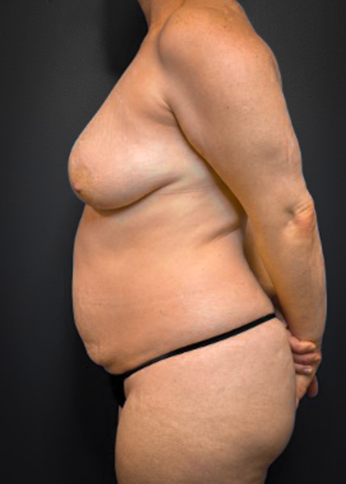 Abdominoplasty-Case--5347 | Before Body 2