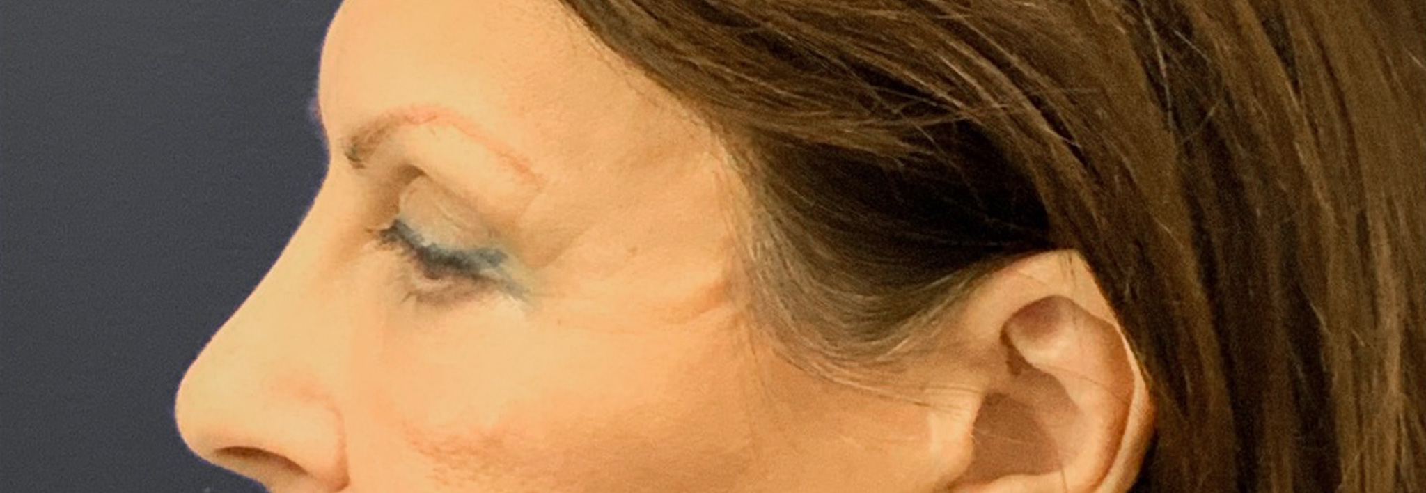 Blepharoplasty-Case--6272 | Before Eyelid Surgery 2