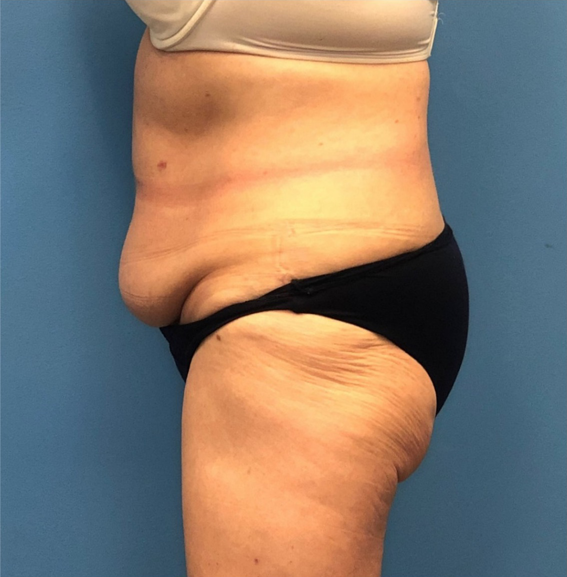 Case--251 | Before Body 2