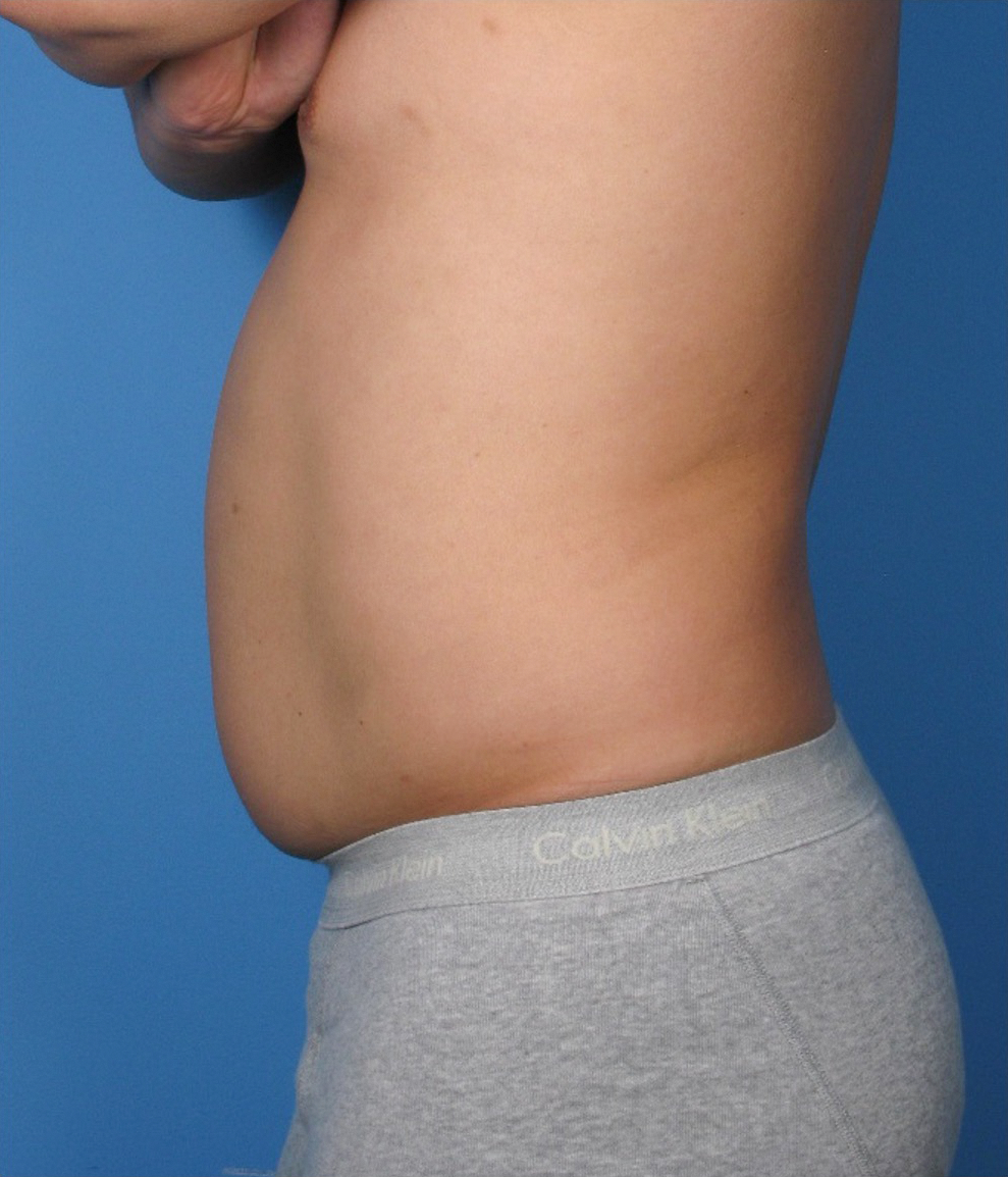 Case--389 | Before Body 2
