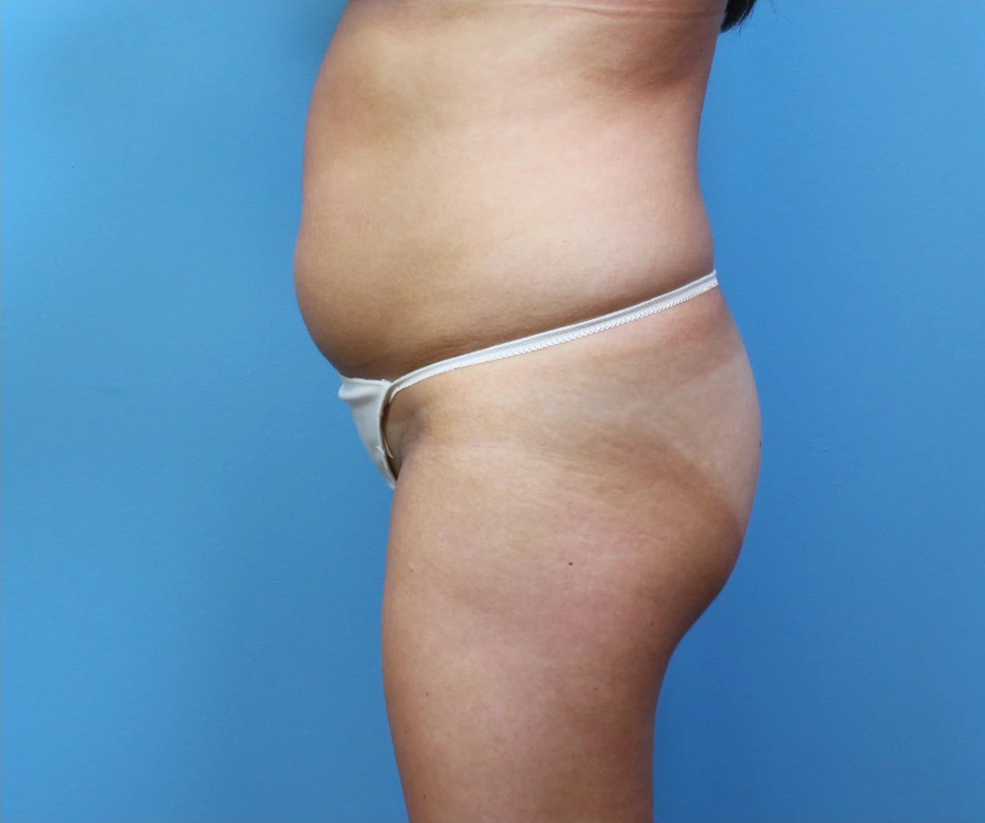 Brazilian-Butt-Lift-Case--265 | Before Brazilian Butt Lift 2