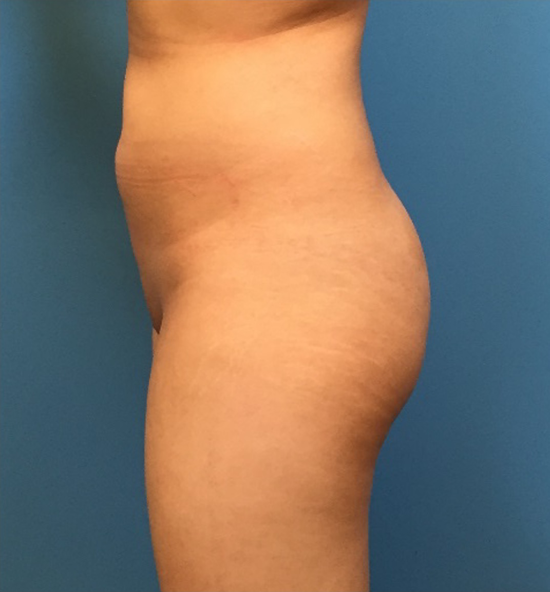 Brazilian-Butt-Lift-Case--73 | Before Body 2