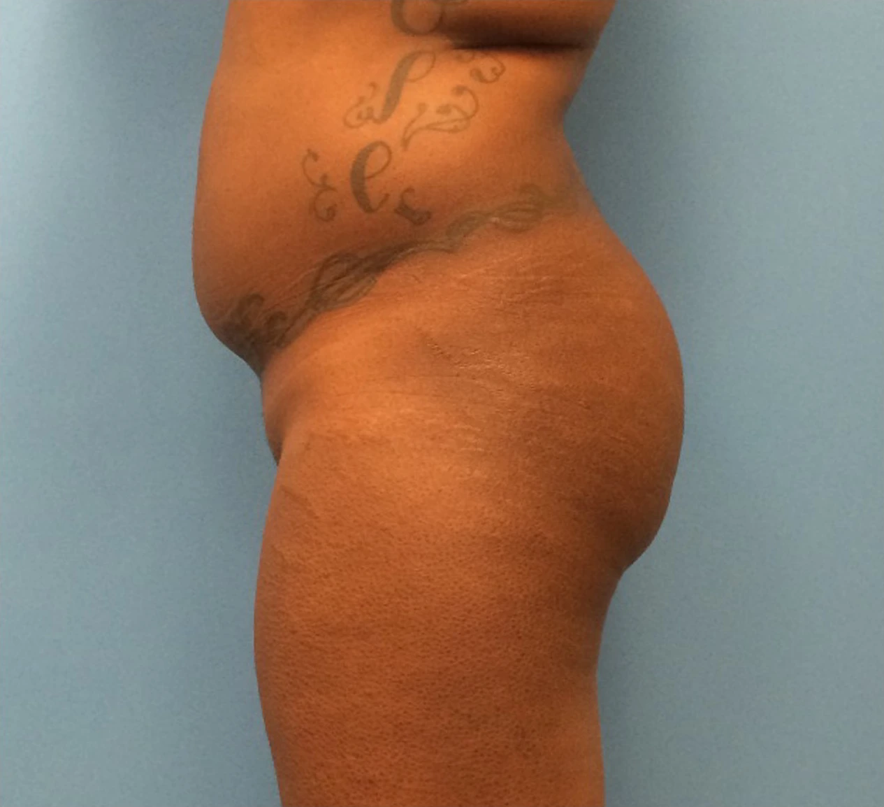 Brazilian-Butt-Lift-Case--271 | Before Brazilian Butt Lift 2