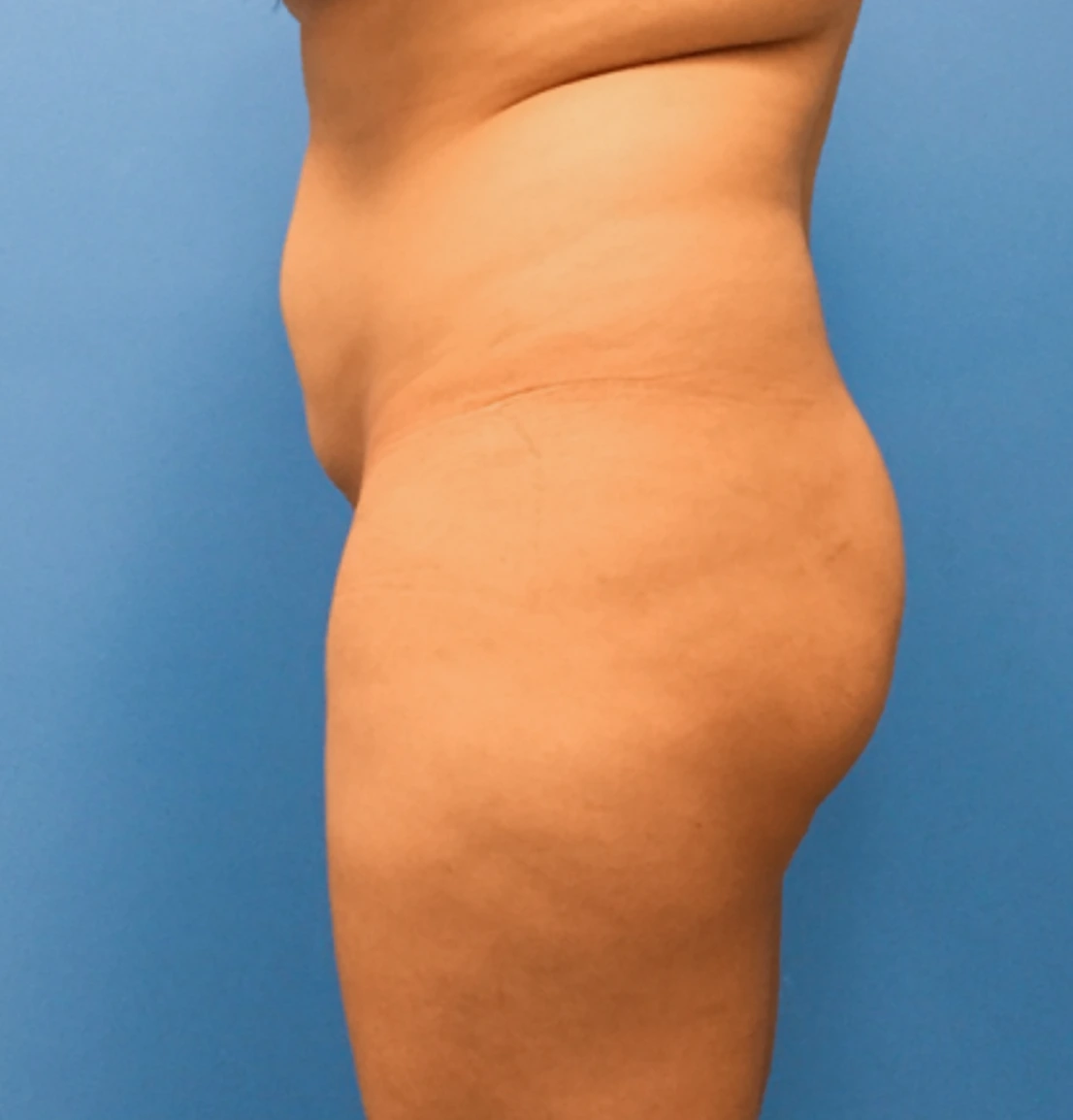 Brazilian-Butt-Lift-Case--272 | Before Brazilian Butt Lift 4