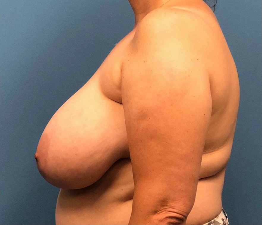 Breast-Reduction-Case--13597 | Before Breast Reduction 3