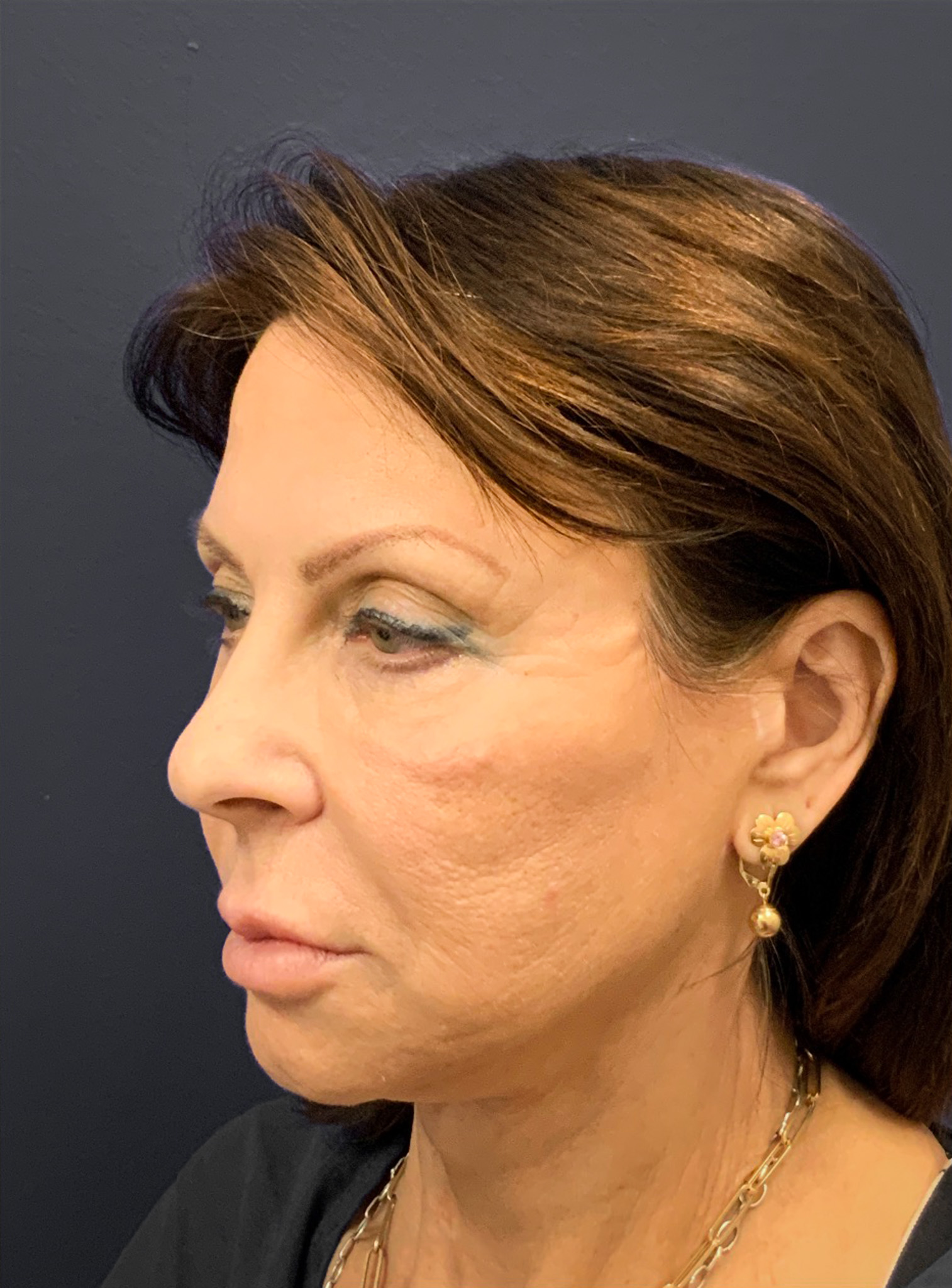 Blepharoplasty-Case--6272 | Before Eyelid Surgery 9