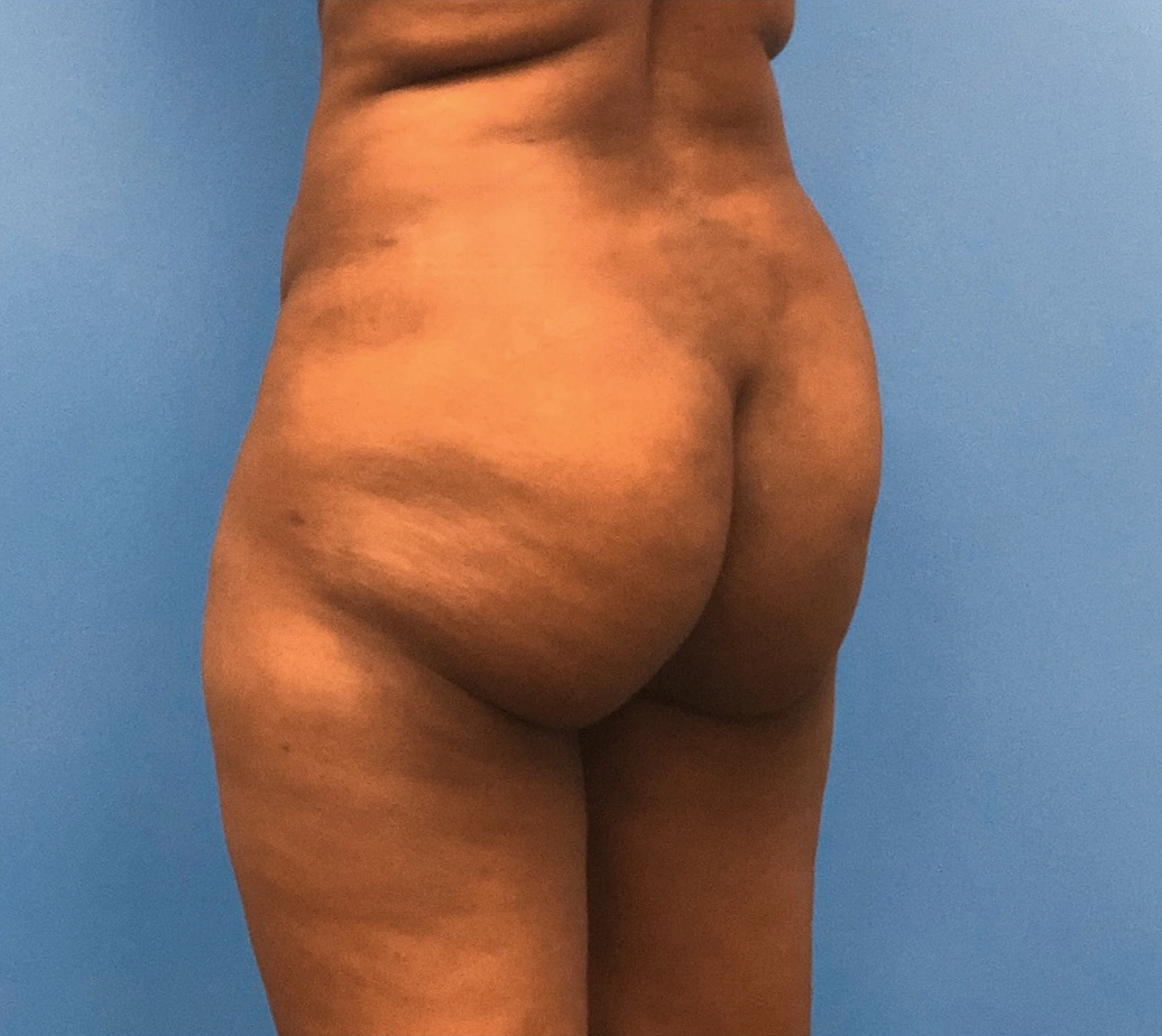 Brazilian-Butt-Lift-Case--267 | Before Brazilian Butt Lift 1