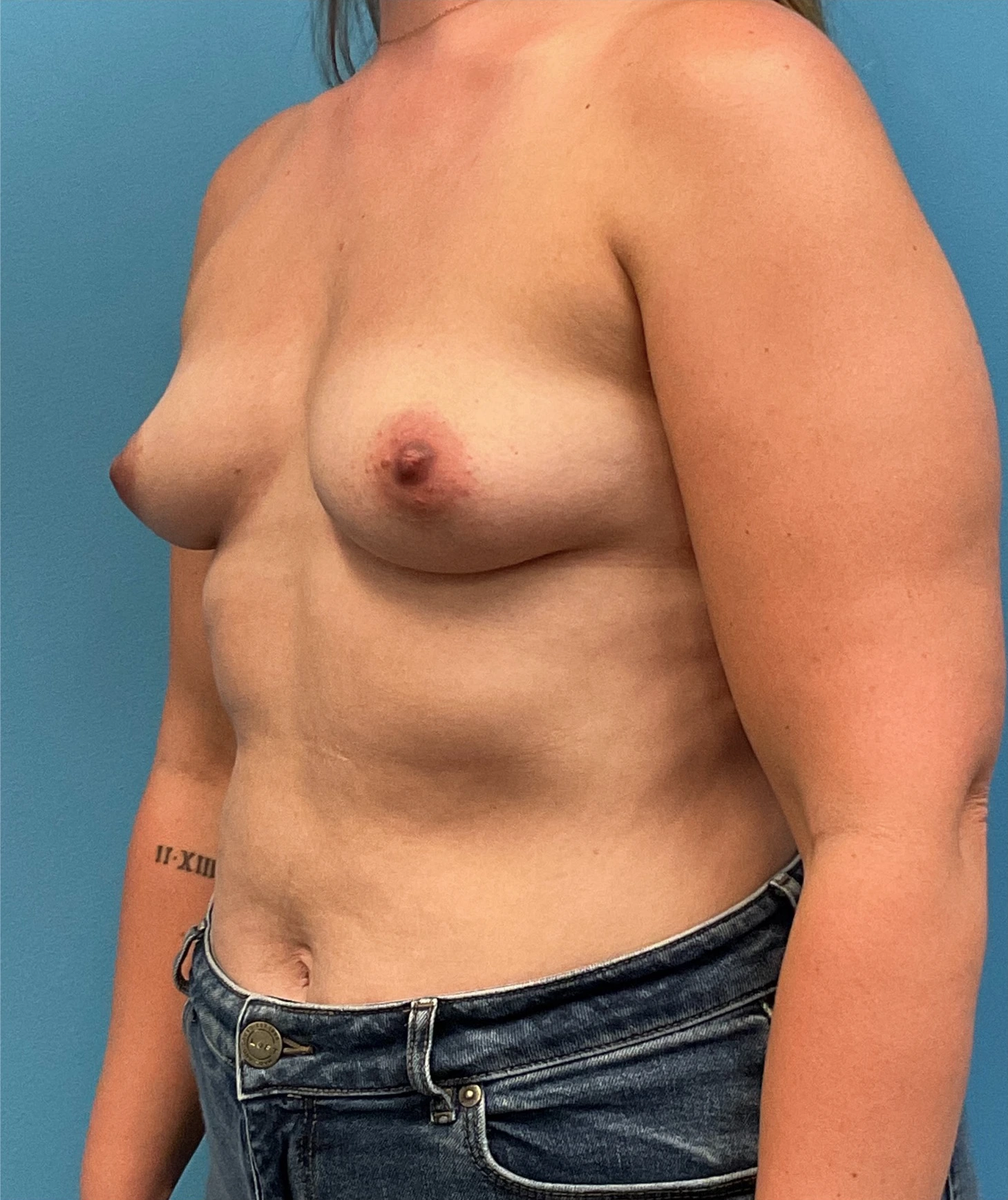 Before Breast Augmentation (Left Oblique)