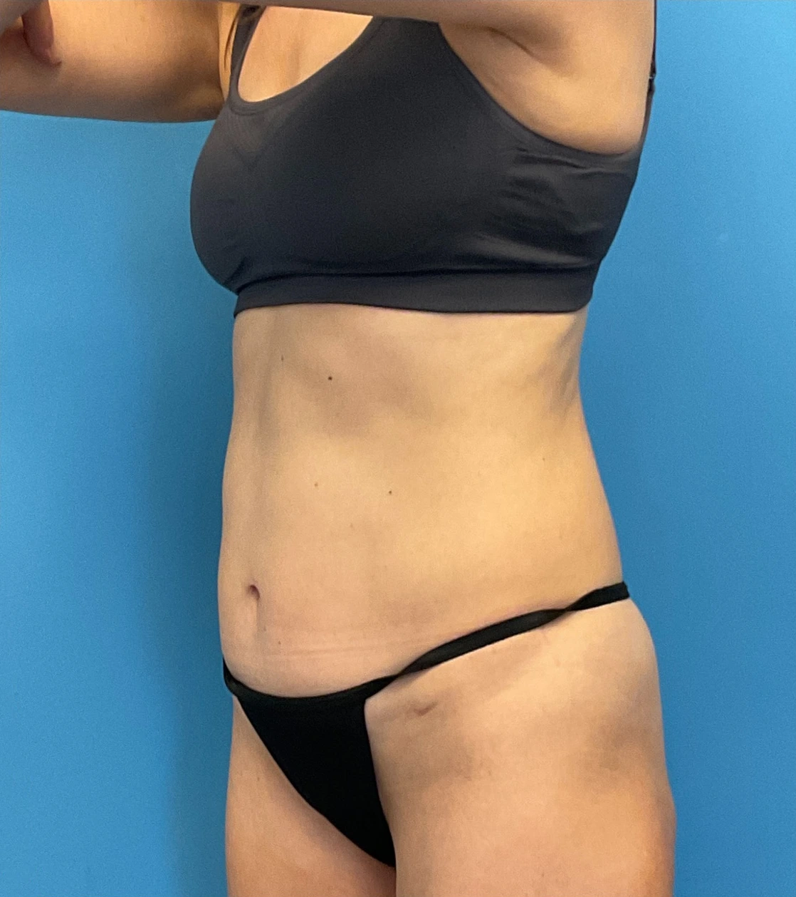 Revision-Tummy-Tuck-Case--23643 | Before Tummy Tuck 2