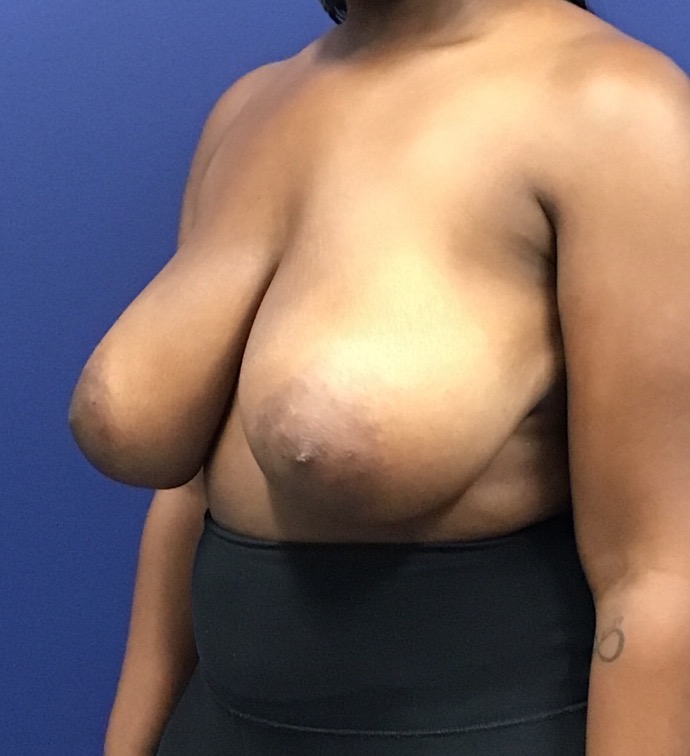 Breast-Reduction-Case--27530 | Before Dr. Arjun Kanuri 2