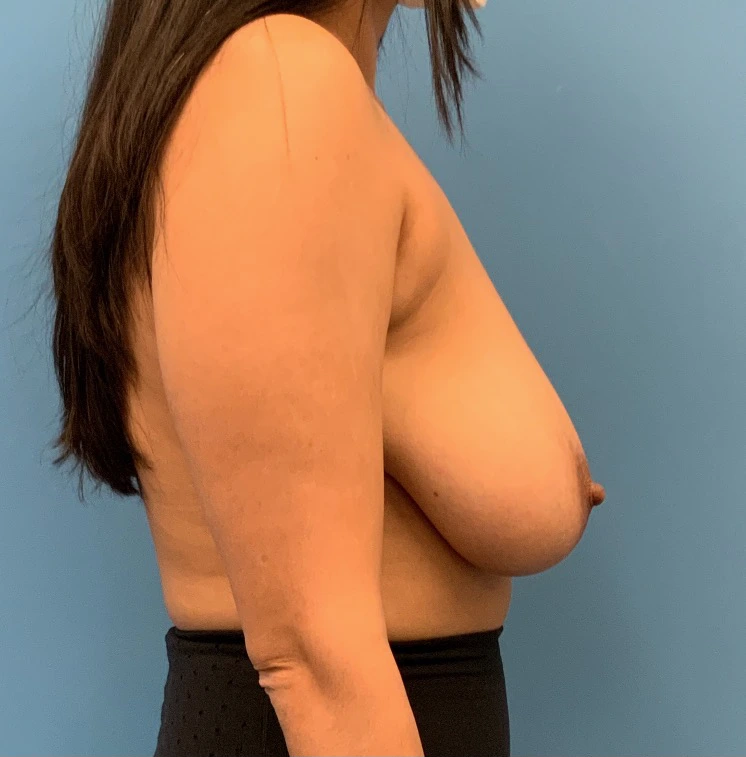 Breast-Reduction-Case--24290 | Before Breast Reduction 5