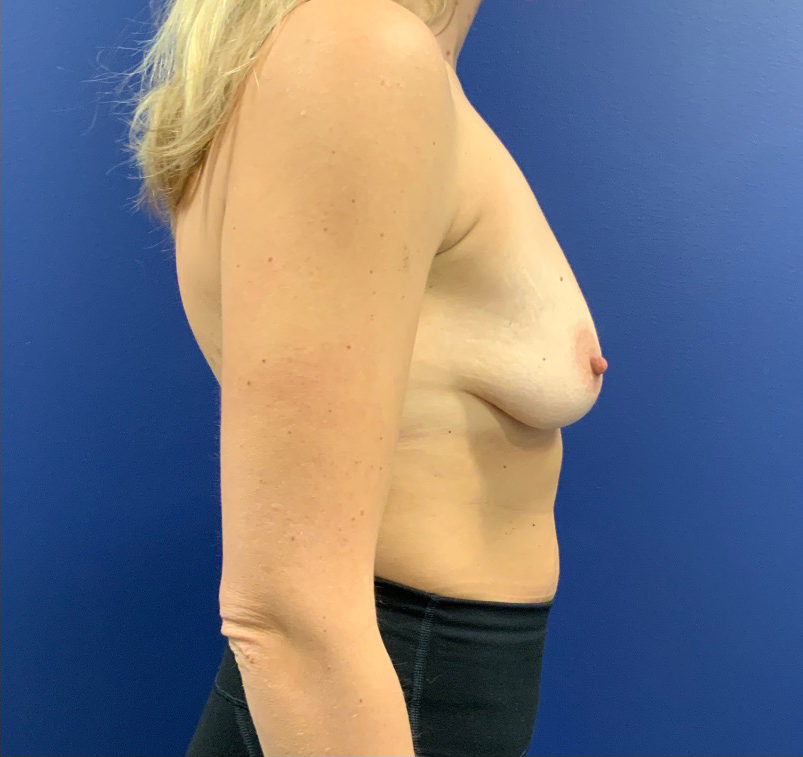 Breast-Augmentation-Case--20570 | Before Breast Augmentation 5