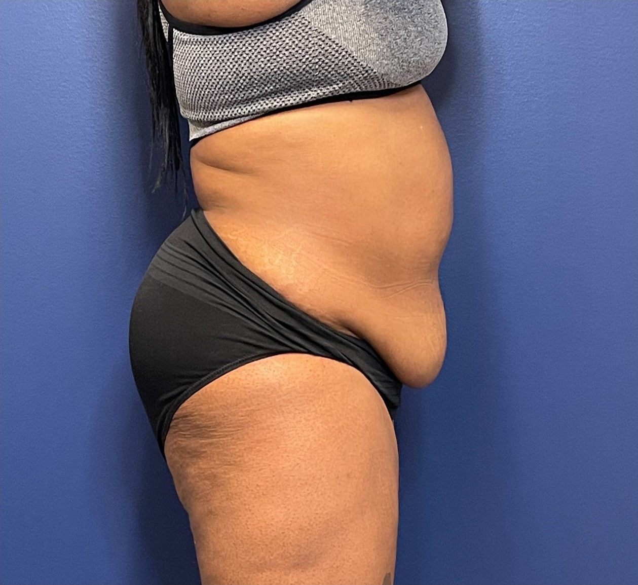 Lipoabdominoplasty-Case--245 | Before Body 2