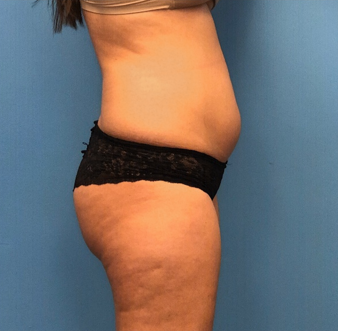 Lipo-360-Case--277 | Before Body 2
