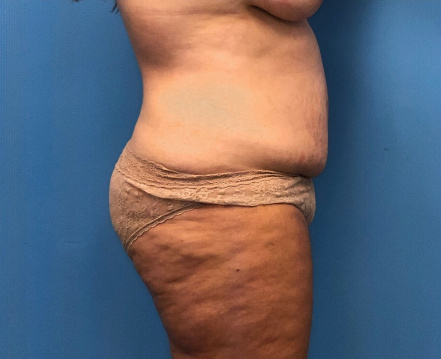 Case--252 | Before Body 2