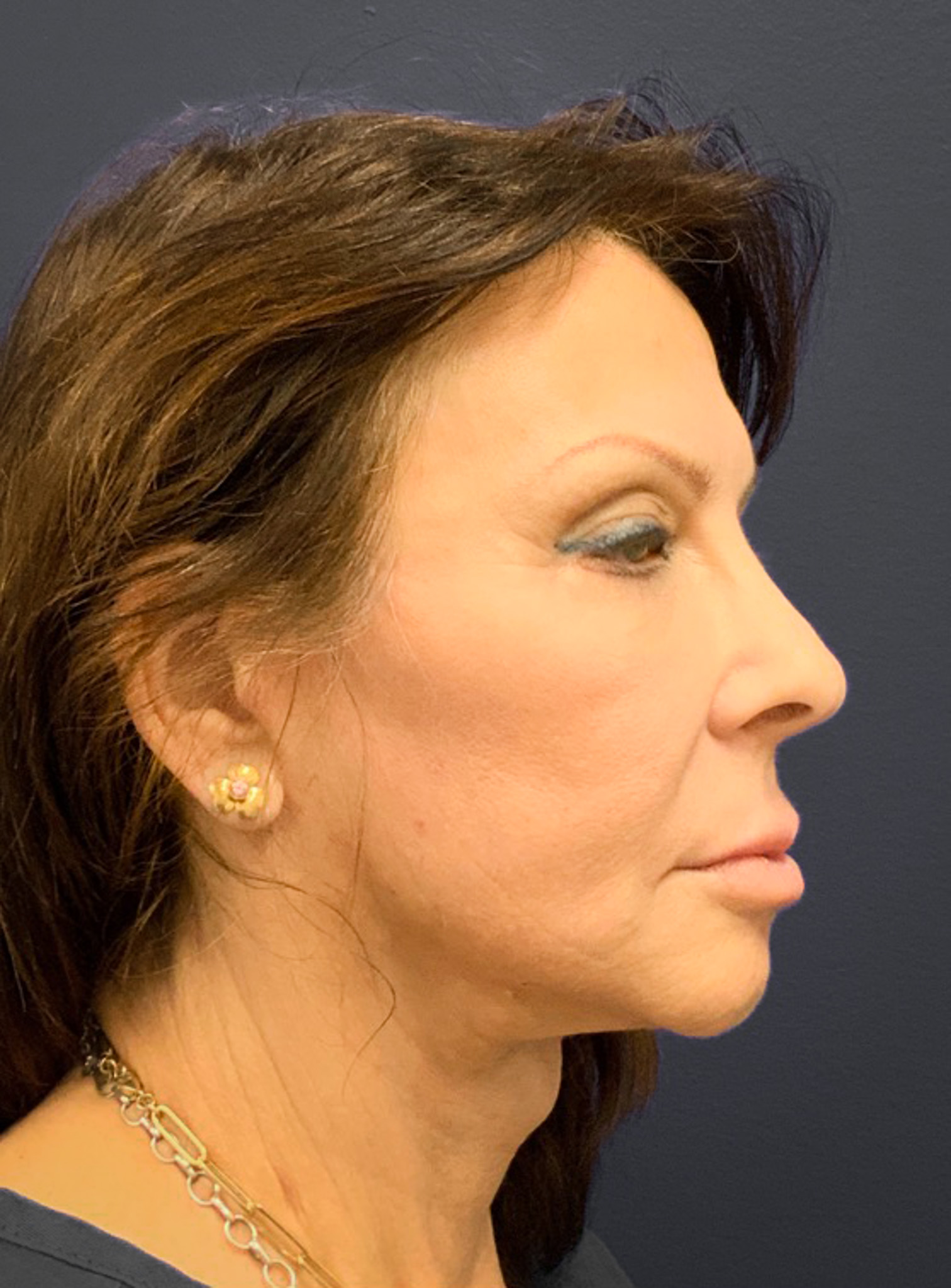 Blepharoplasty-Case--6272 | Before Eyelid Surgery 8