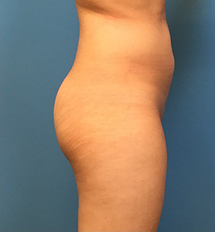 Brazilian-Butt-Lift-Case--73 | Before Brazilian Butt Lift 3