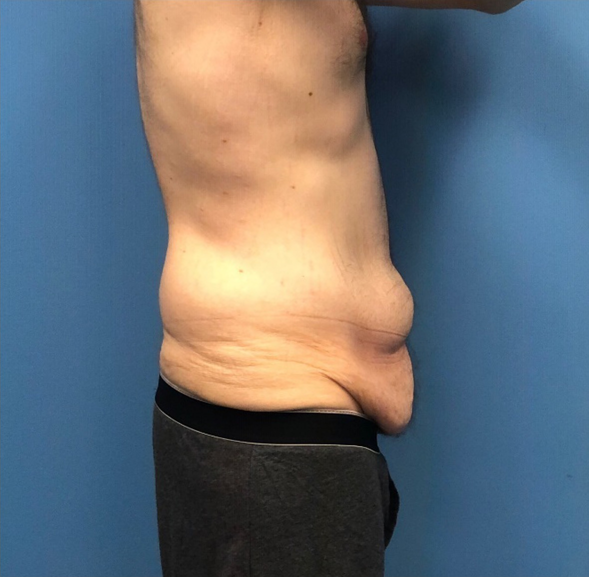 Body-Lift-Case--273 | Before Body 2