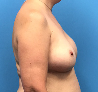 Case--136 | Before Breast Reconstruction 3
