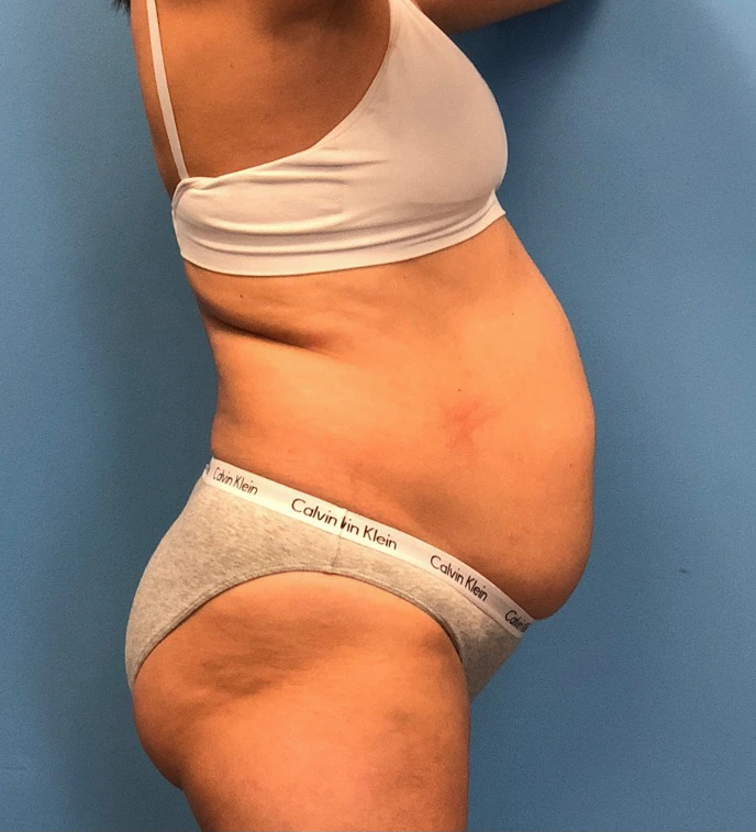 Case--14819 | Before Liposuction 3