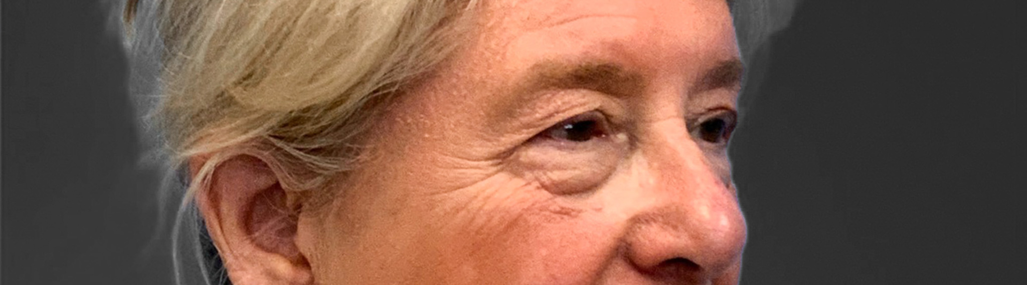 Blepharoplasty-Case--3336 | Before Eyelid Surgery 4