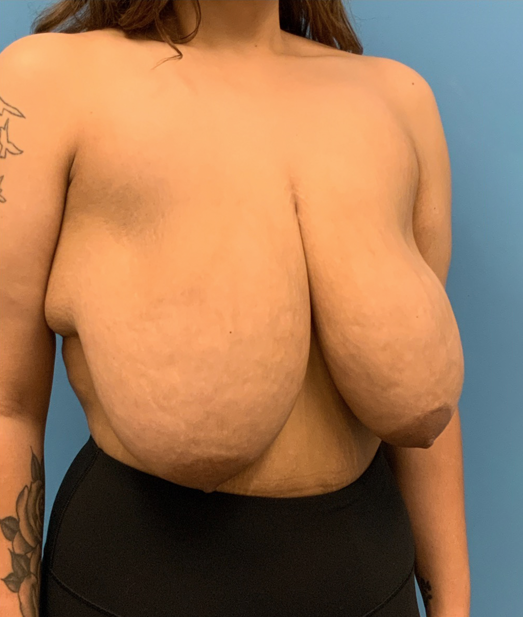 Breast-Reduction-Case--212 | Before Breast Reduction 3