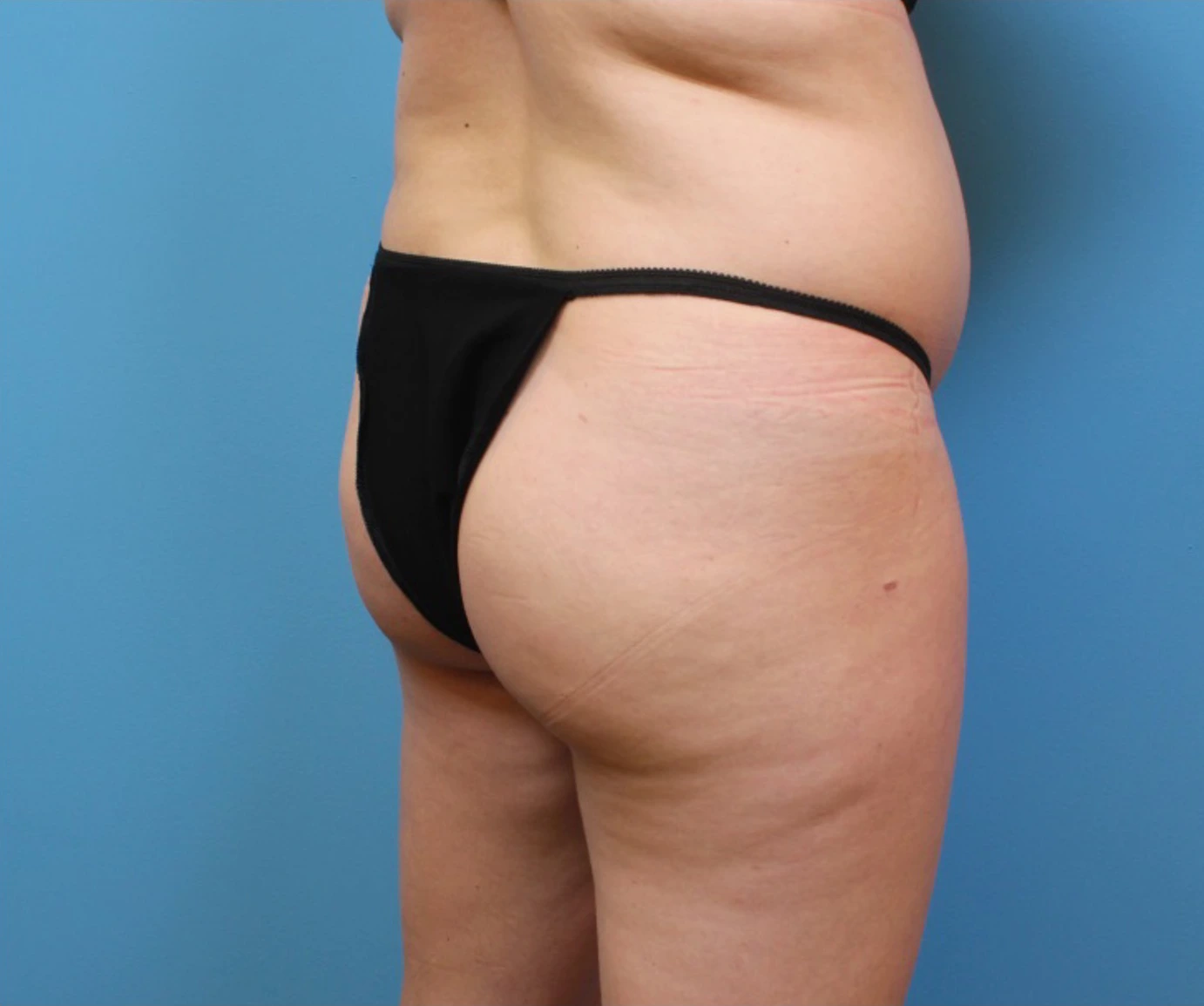Brazilian-Butt-Lift-Case--266 | Before Brazilian Butt Lift 1