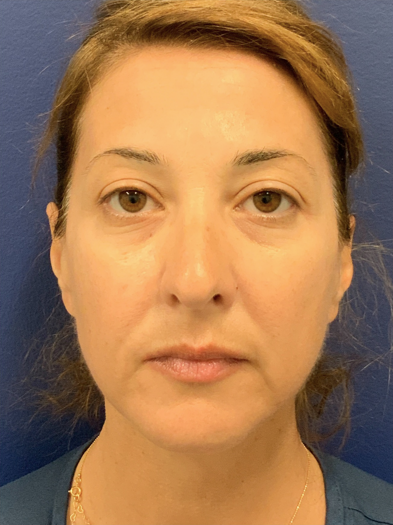 Facelift-360-Facial-Fat-Graft-Blepharoplasty-Neck-Lift-Case--6190 | Before Face360 1