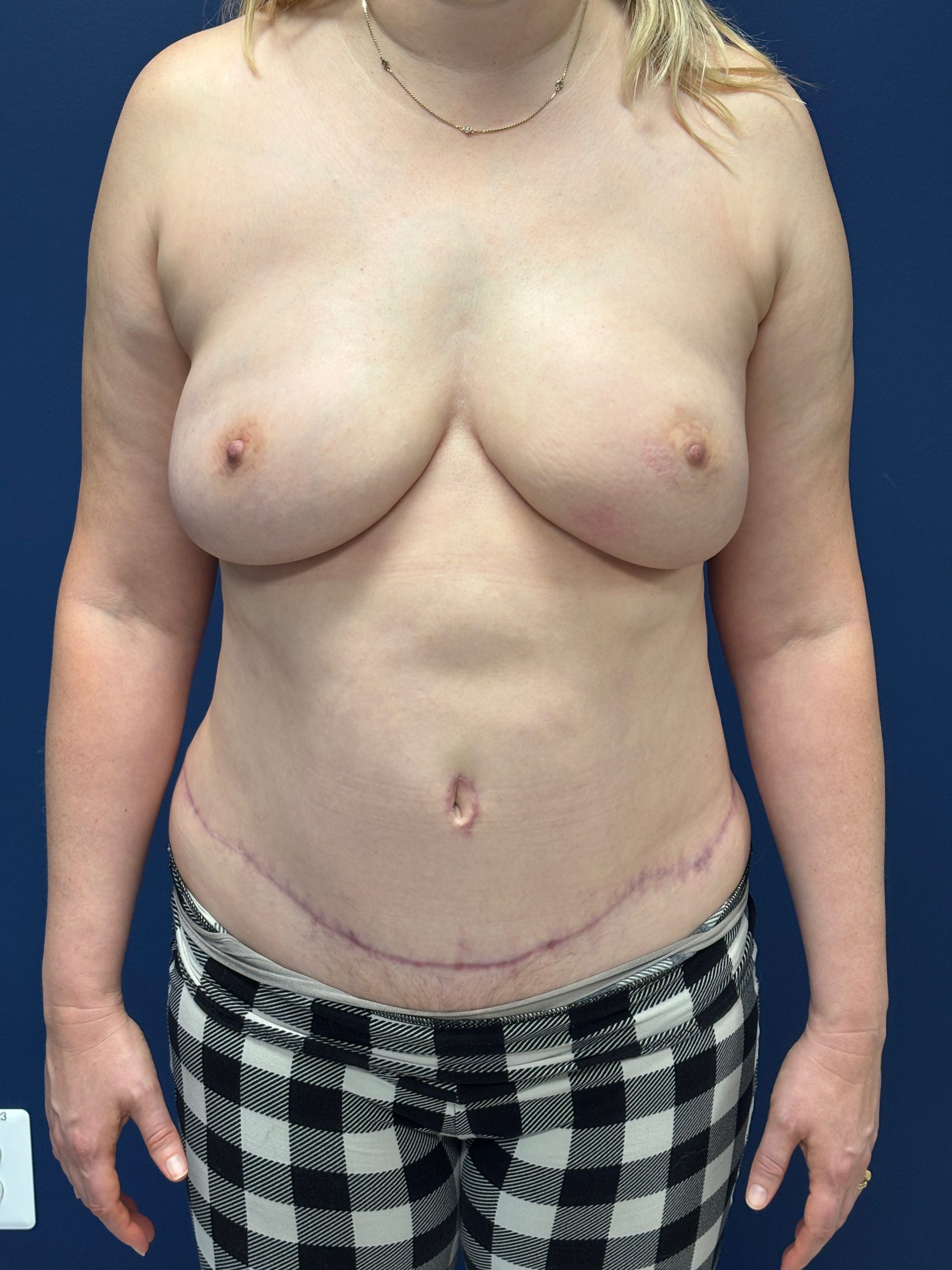 Lipoabdominoplasty-Case--3335 | After Body 1