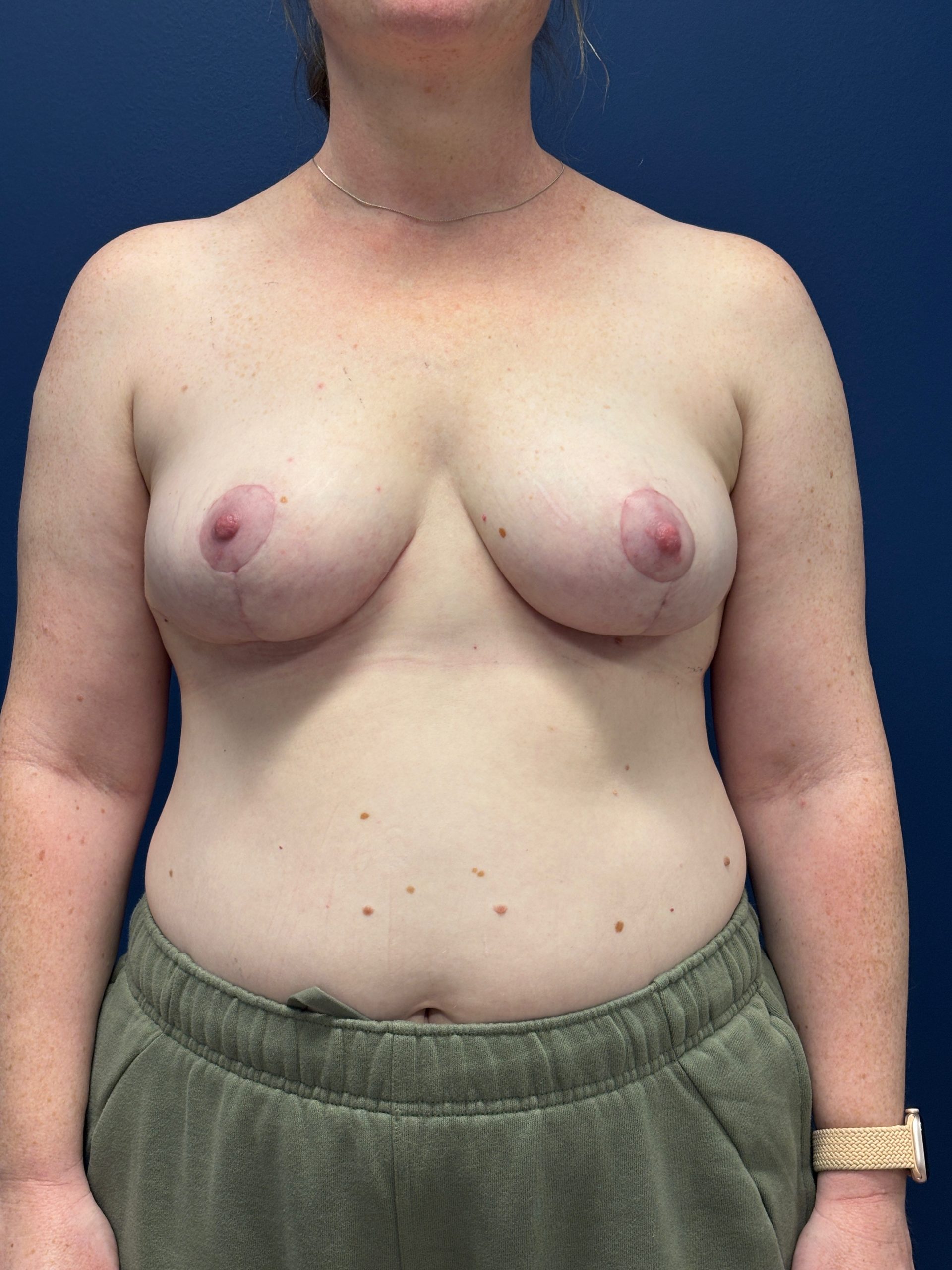 Breast-Reduction-Case--5738 | After Breast Reduction 1