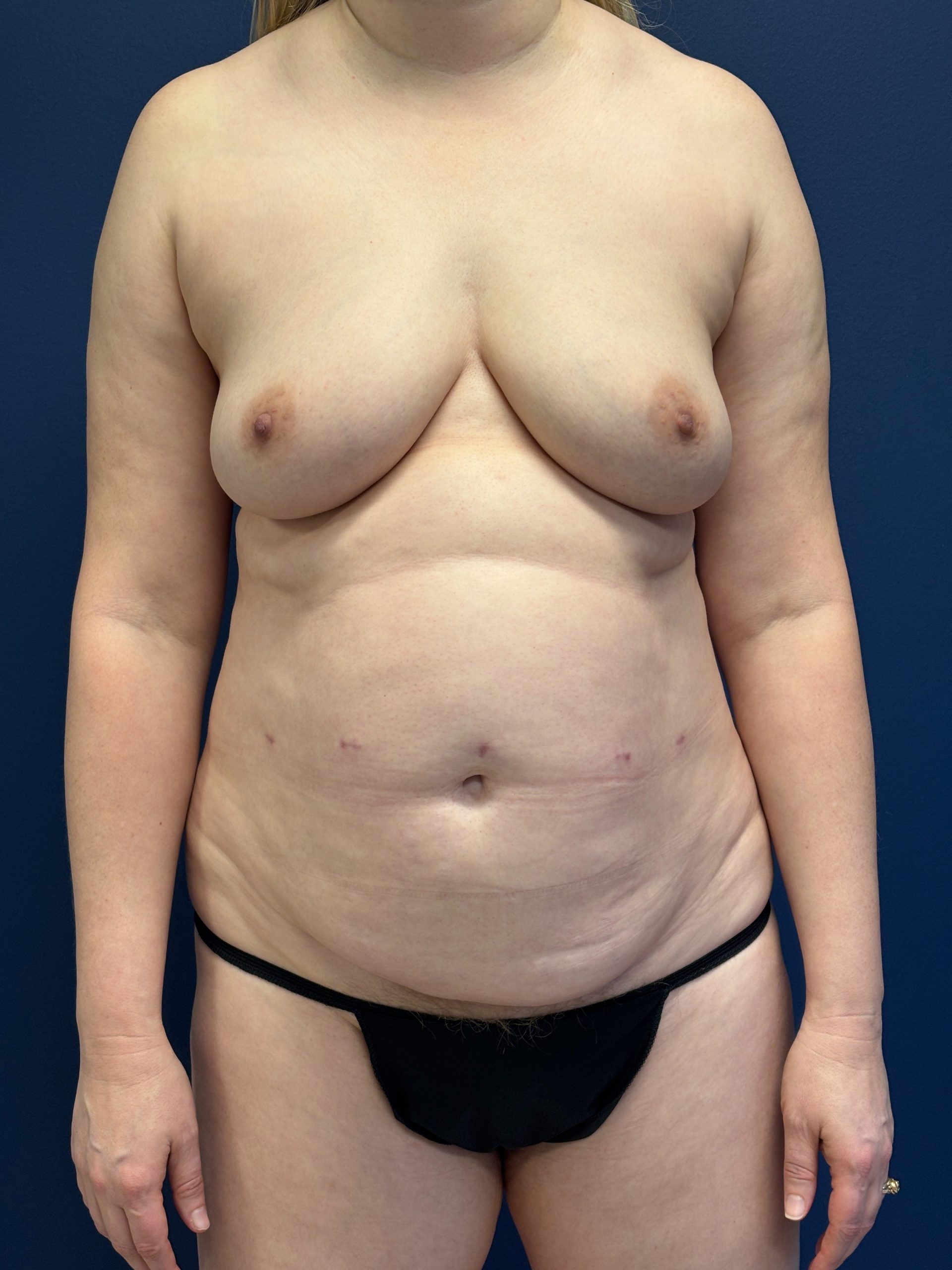Lipoabdominoplasty-Case--3335 | Before Body 1