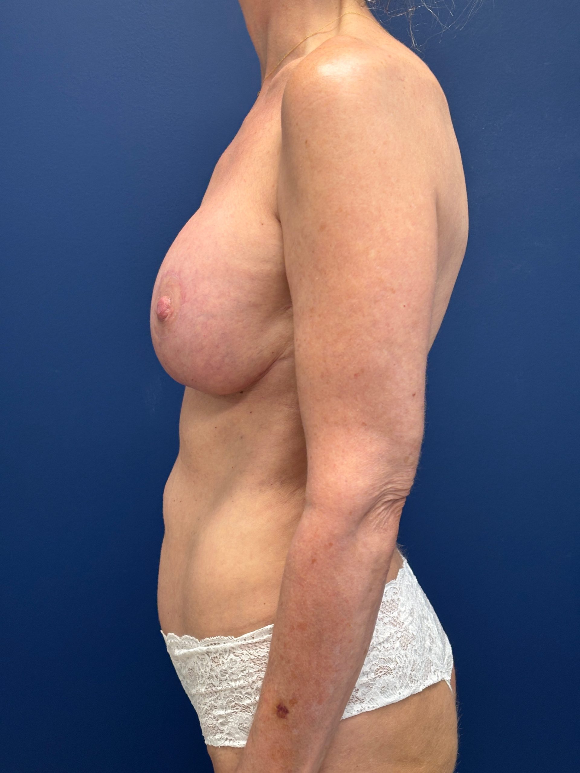 Augmentation-Mastopexy-Case--3055 | After Breast Augmentation With Lift 2