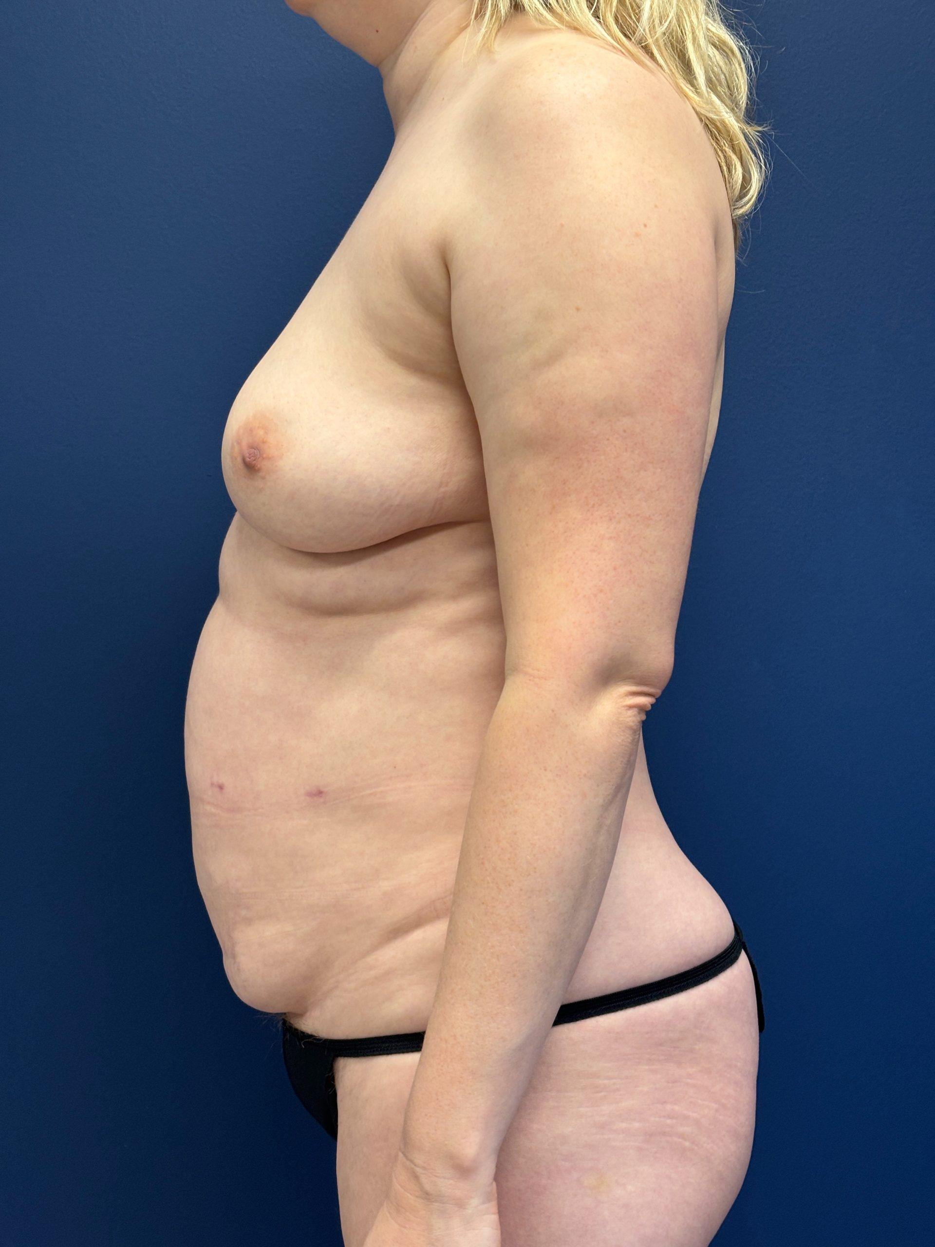 Lipoabdominoplasty-Case--3335 | Before Body 2