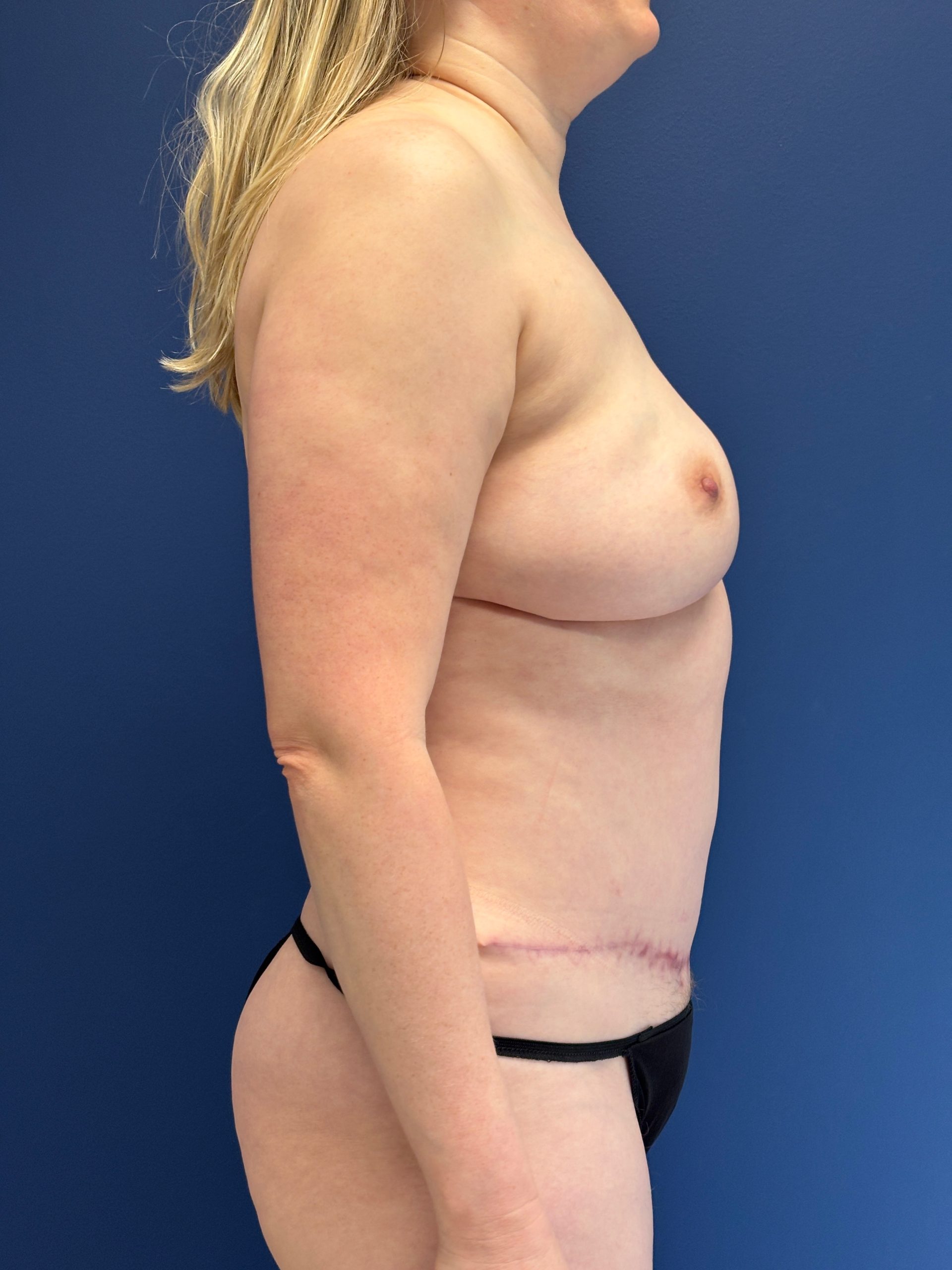 Revision-Breast-Reconstruction-Case--9545 | After Breast Reconstruction 3