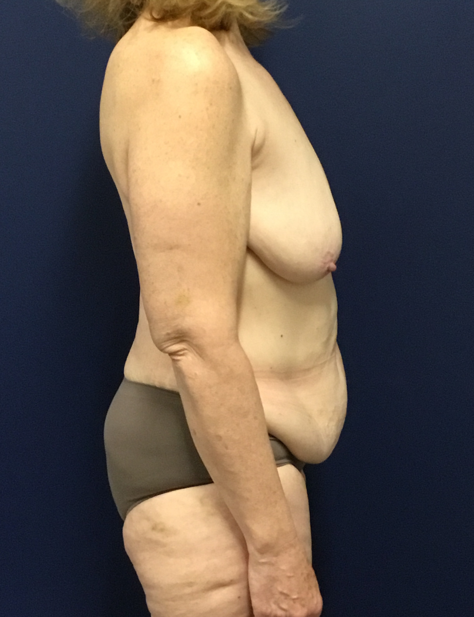 Abdominoplasty-Case--7412 | Before Body 2