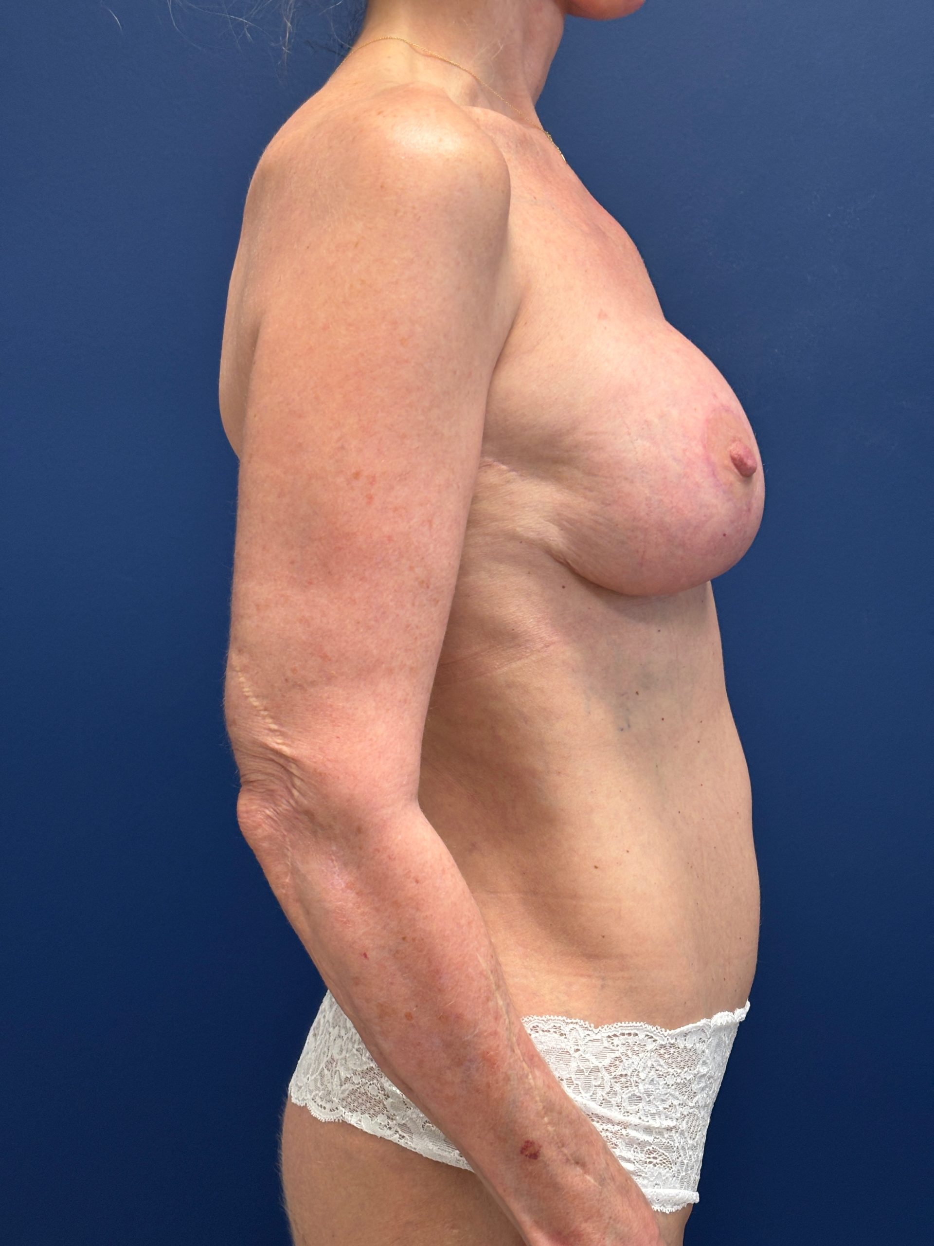Augmentation-Mastopexy-Case--3055 | After Breast Augmentation With Lift 3