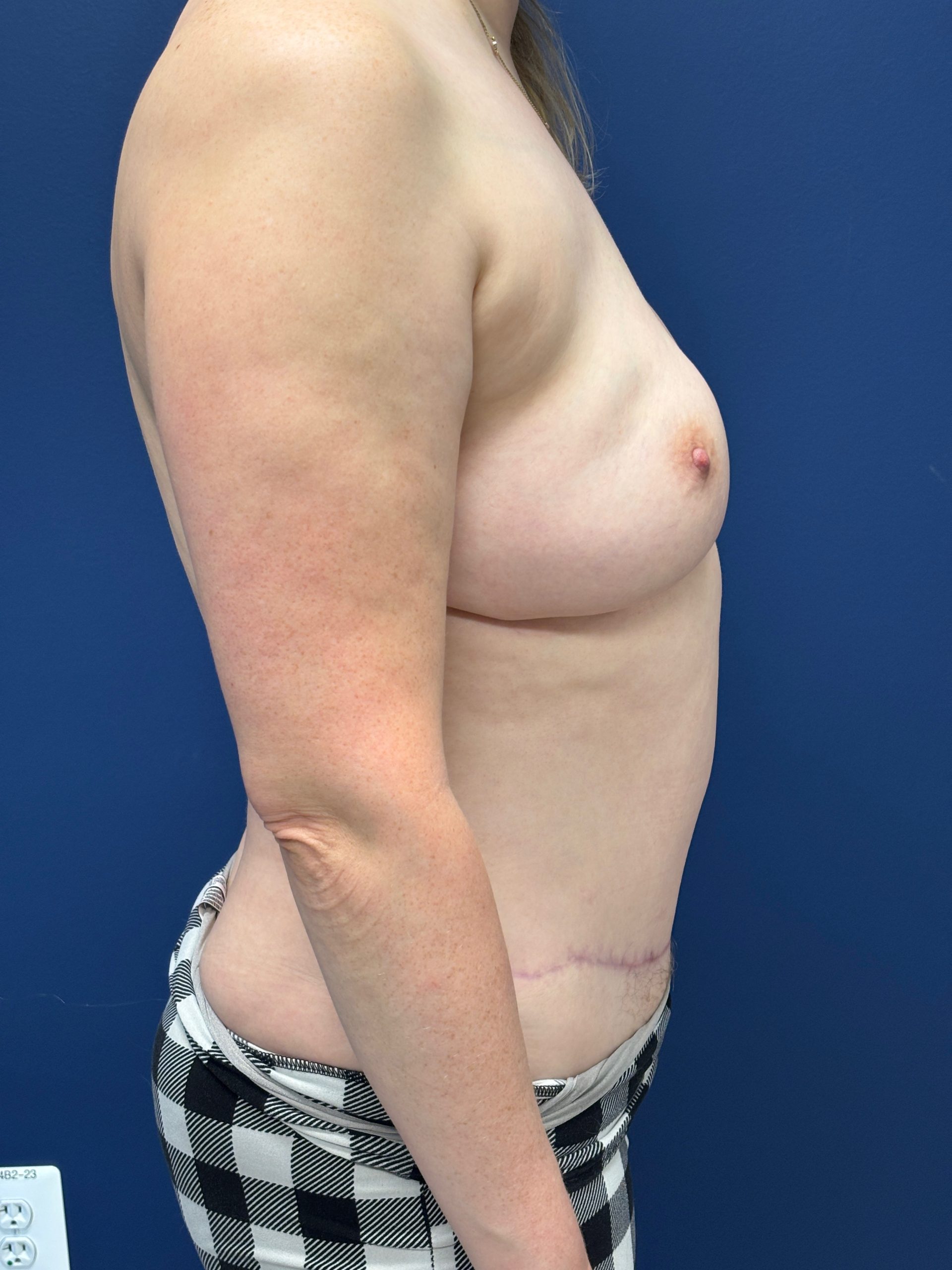 Lipoabdominoplasty-Case--3335 | After Liposuction 3