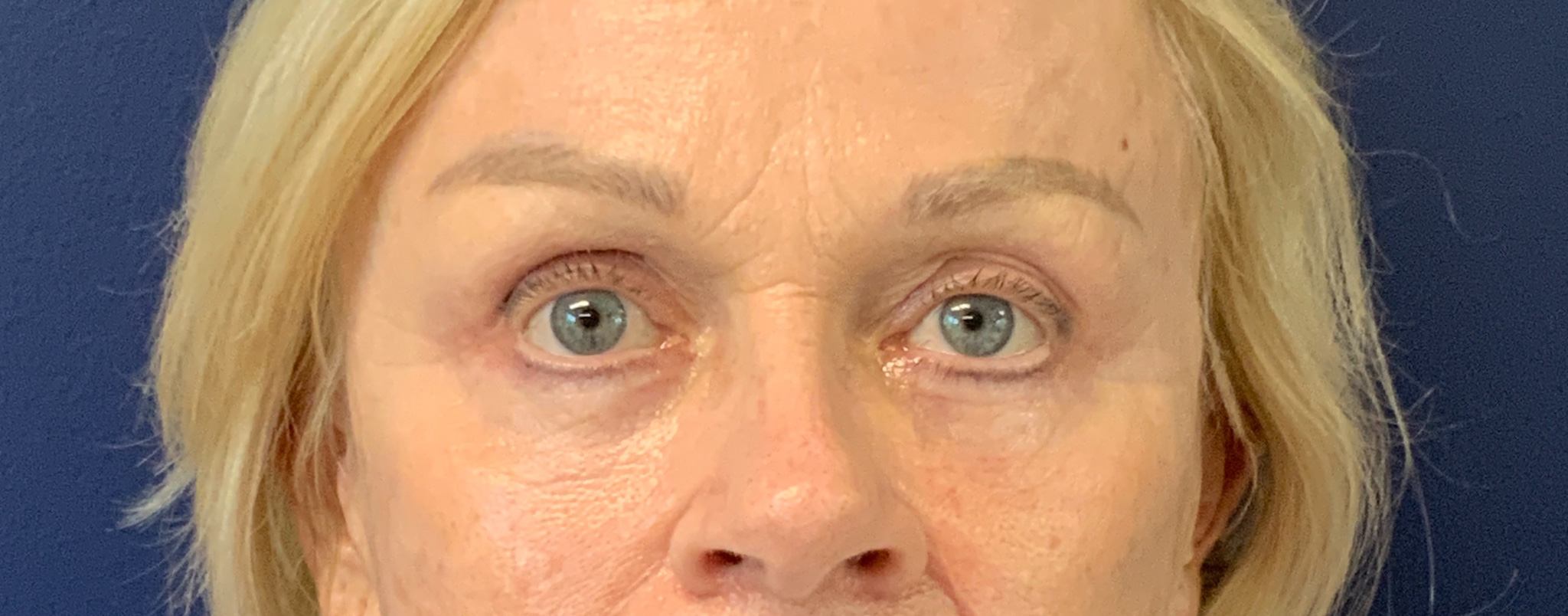 Blepharoplasty-and-Brow-Lift-Case--3108 | After Dr. Arjun Kanuri 1