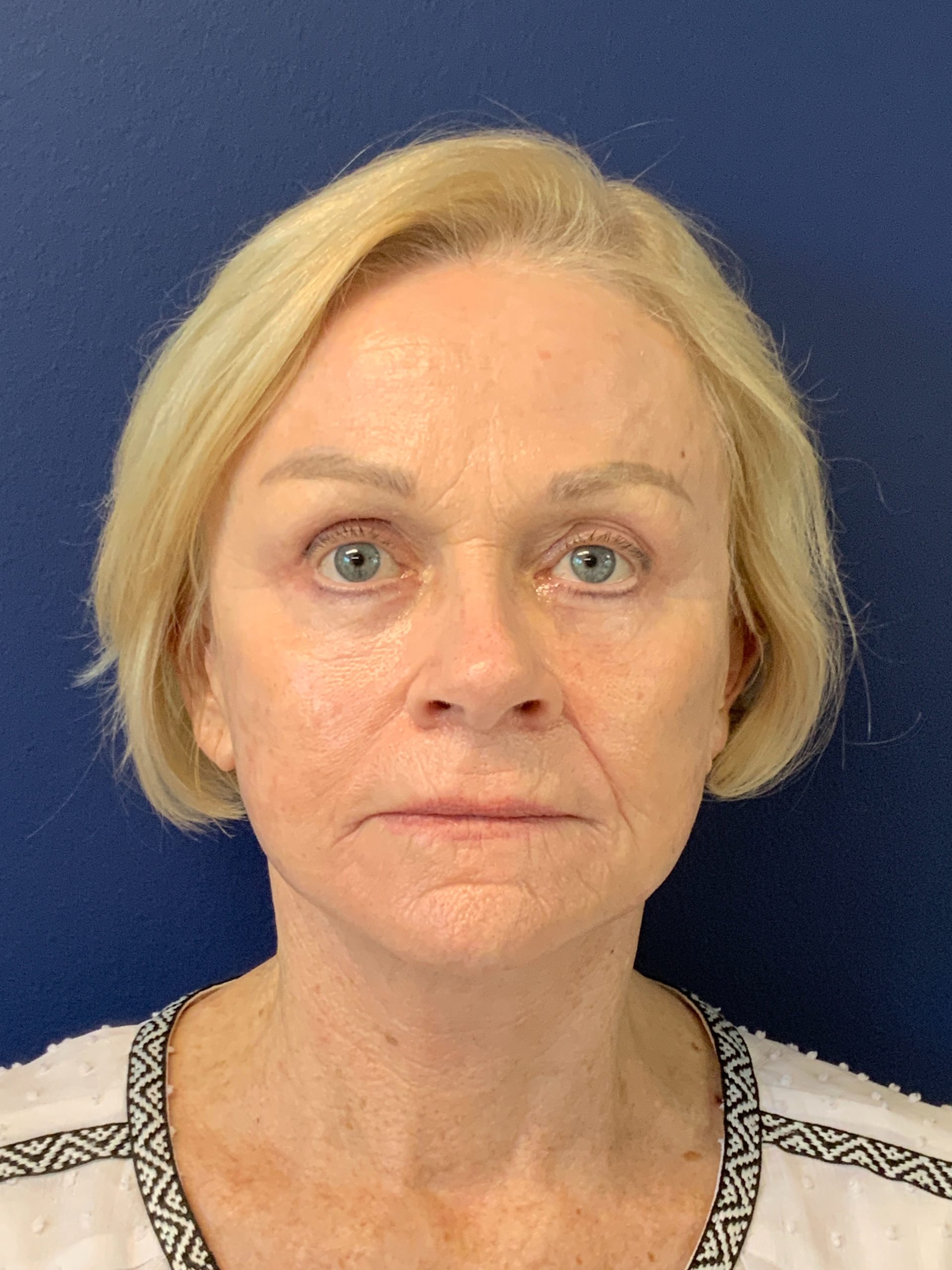 Facelift-360-Facial-Fat-Grafting-Blepharoplasty-Brow-and-Neck-Lift-Case--1433 | After Face360 1