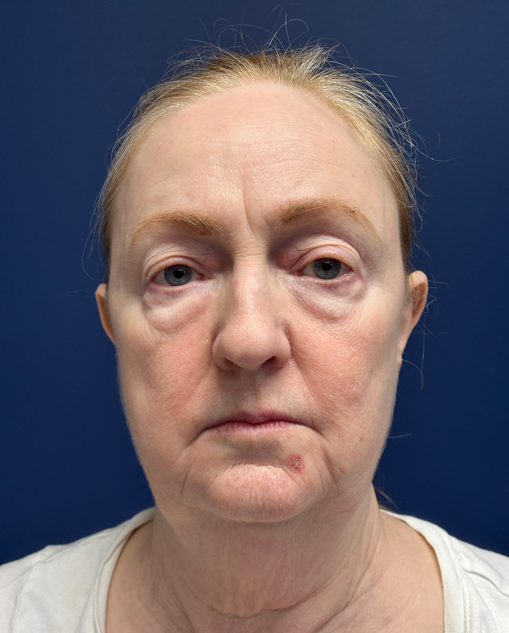 Facelift-Facial-Fat-Graft-Blepharoplasty-Necklift-Case--7934 | Before Face360 1