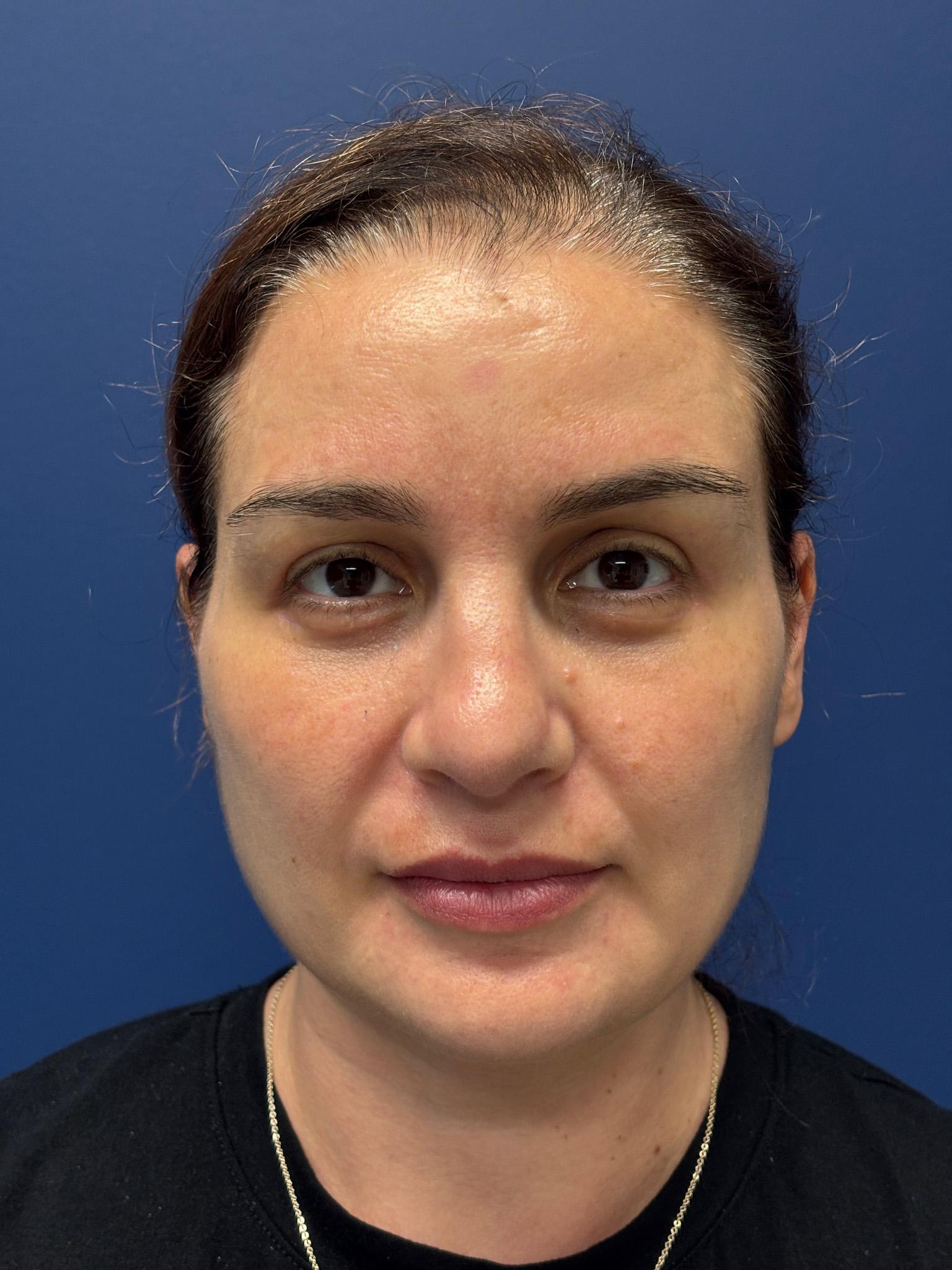 Facelift-and-Facial-Fat-Grafting-Case--7977 | After Facelift 1