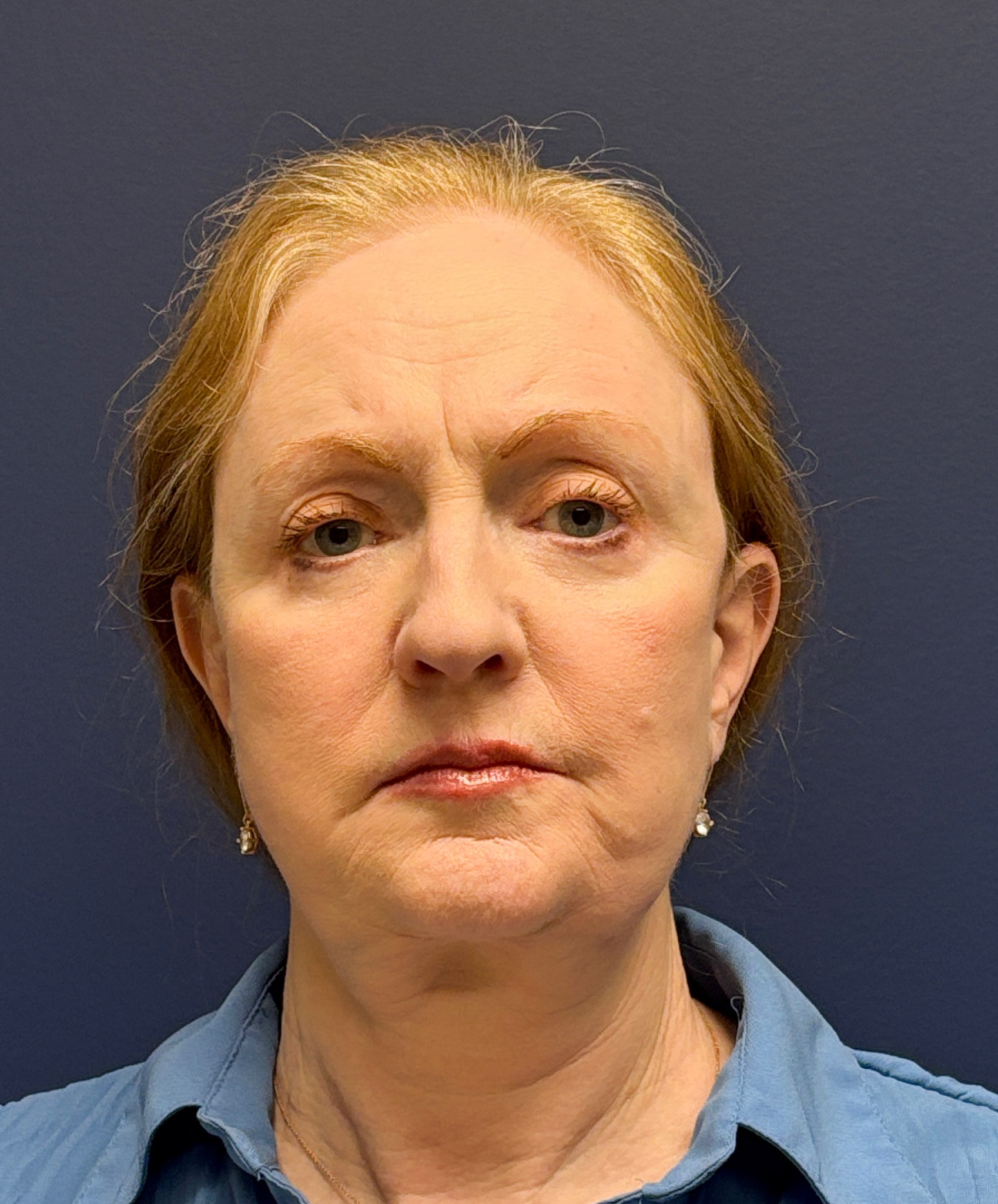 Facelift-Facial-Fat-Graft-Blepharoplasty-Necklift-Case--7934 | After Face360 1