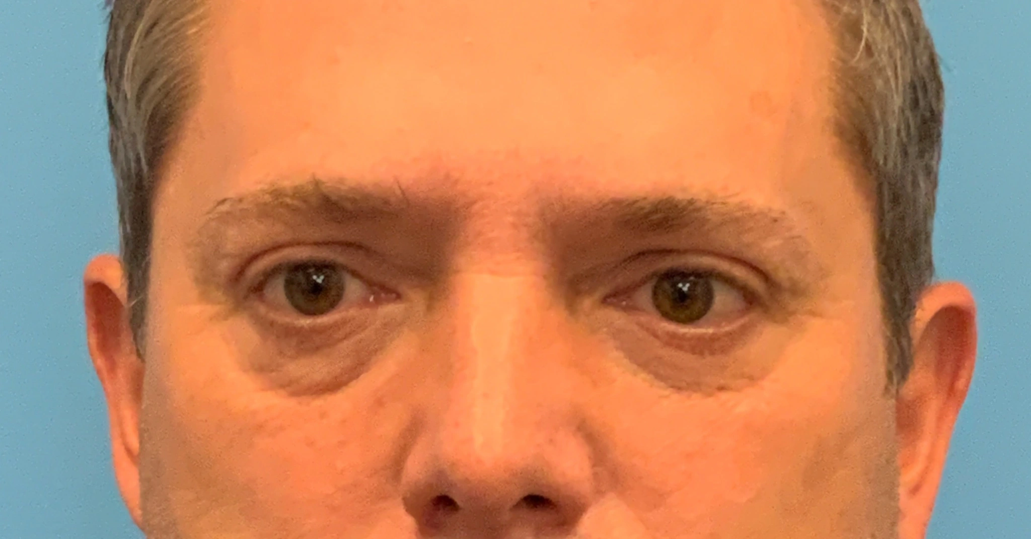 Blepharoplasty-Case--5888 | Before Eyelid Surgery 1