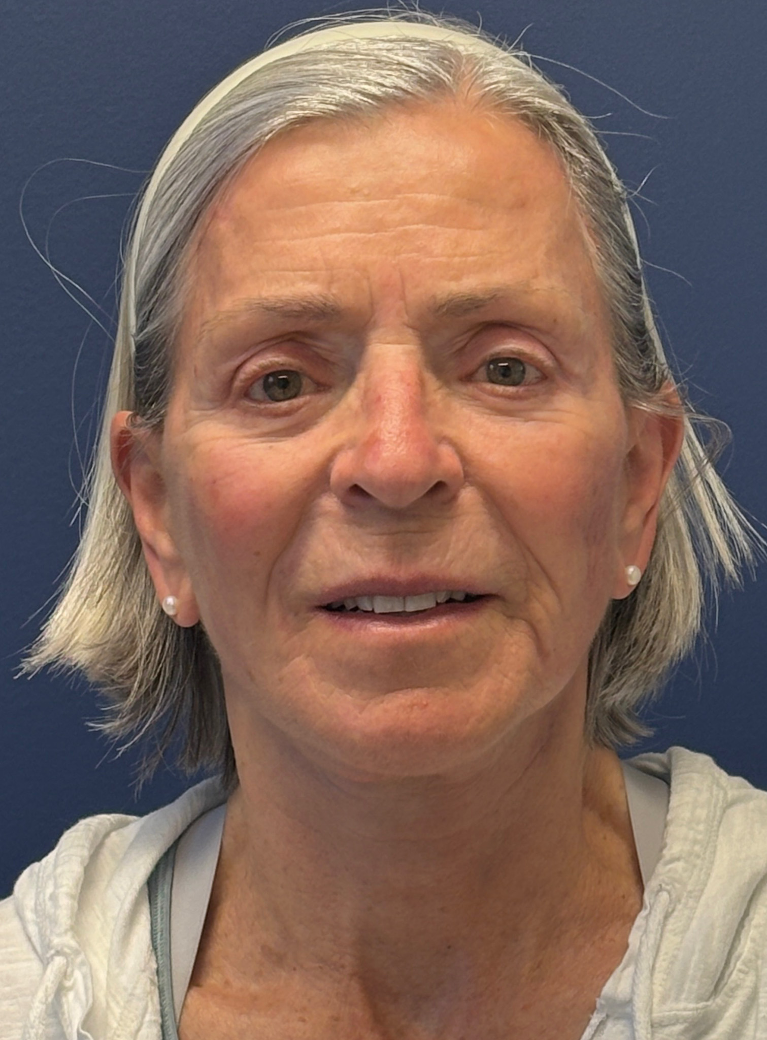 Facelift-Facial-Fat-Grafting-Browlift-Blepharoplasty-Necklift-Case--4176 | After Face360 1
