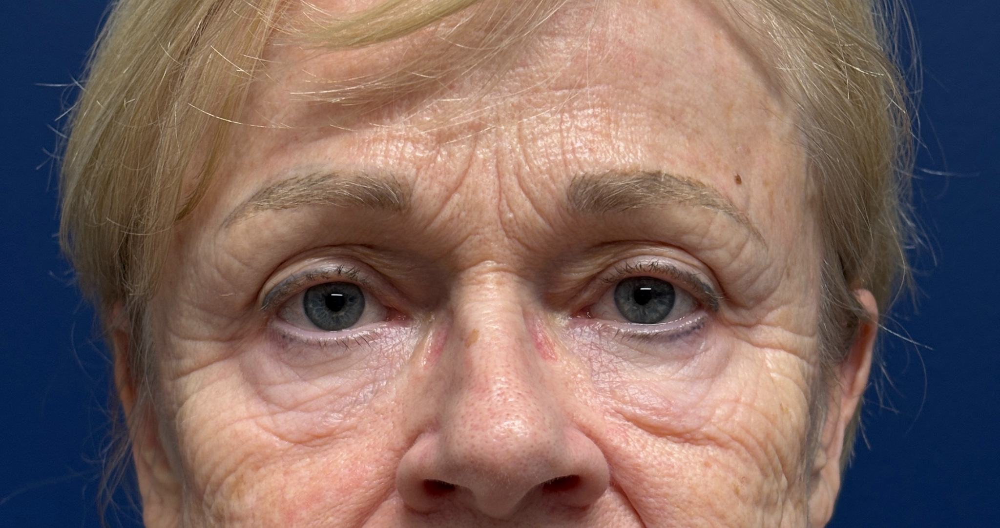 Blepharoplasty-and-Brow-Lift-Case--3108 | Before Dr. Arjun Kanuri 1
