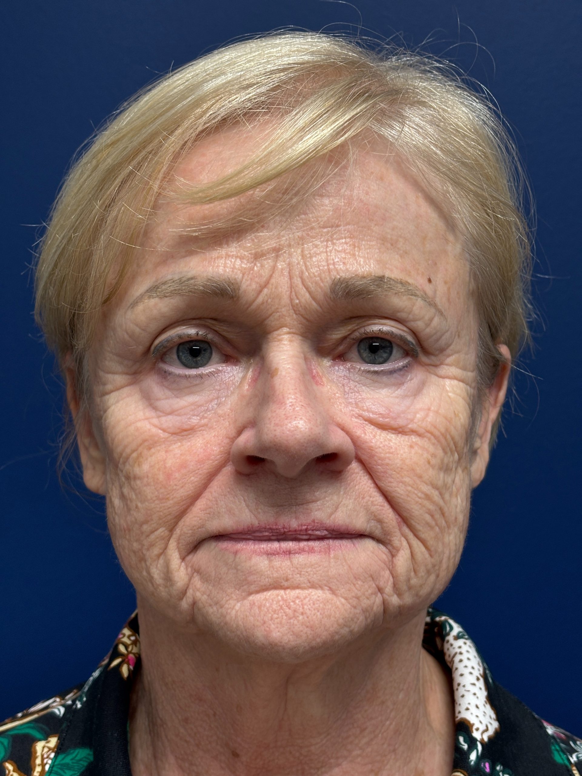 Facelift-360-Facial-Fat-Grafting-Blepharoplasty-Brow-and-Neck-Lift-Case--1433 | Before Face360 1